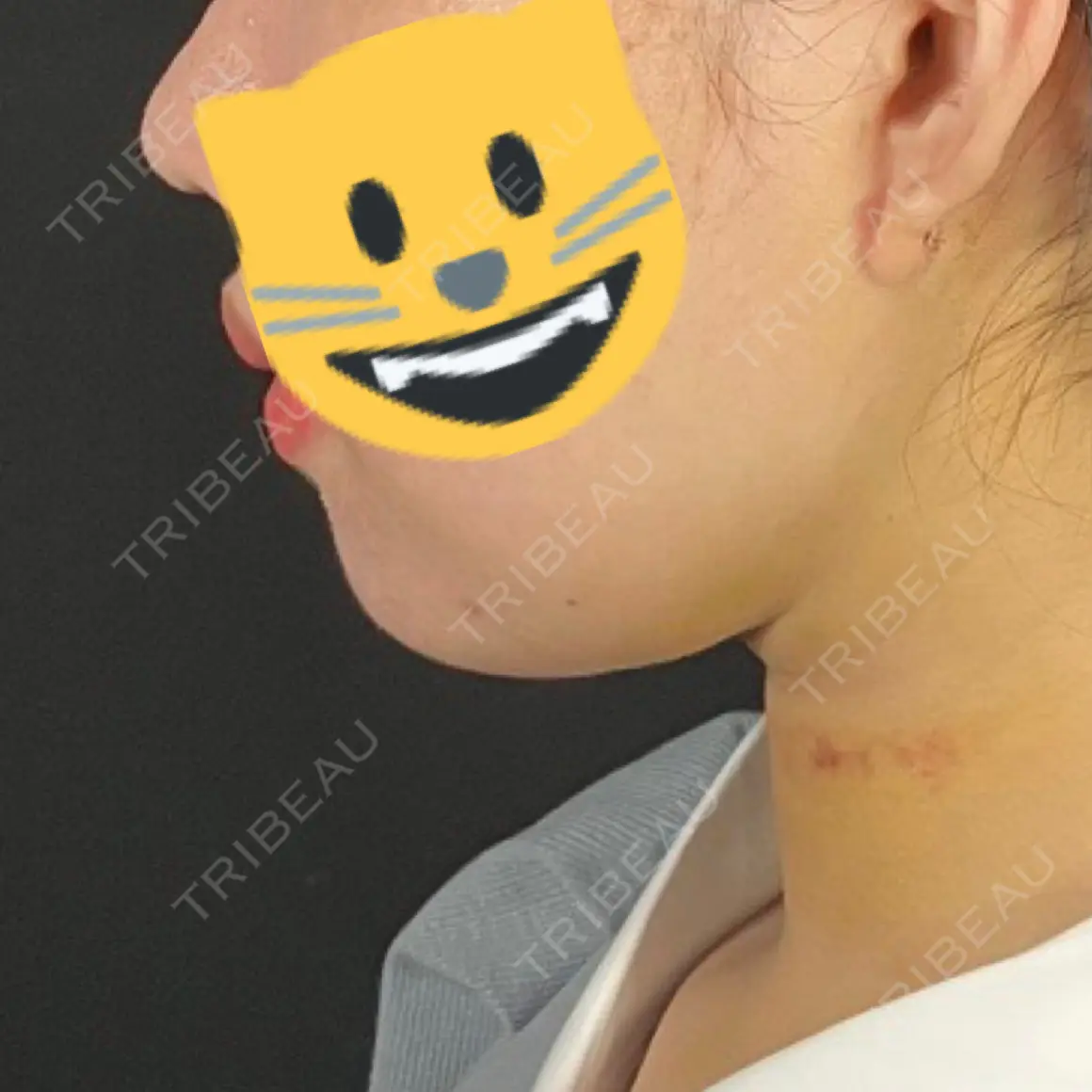 脂肪吸引（顔） TOTAL BEAUTY CLINIC DAY 5