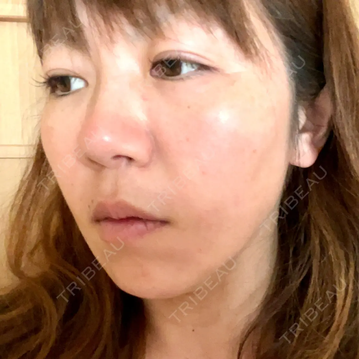 ヴェルヴェットスキン くさのたろうクリニック AFTER