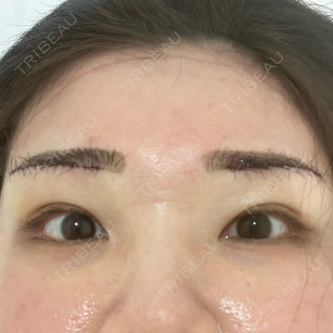 上まぶたの脂肪取り / 眉下切開 Otus Clinic 【オータスクリニック】 DAY 0