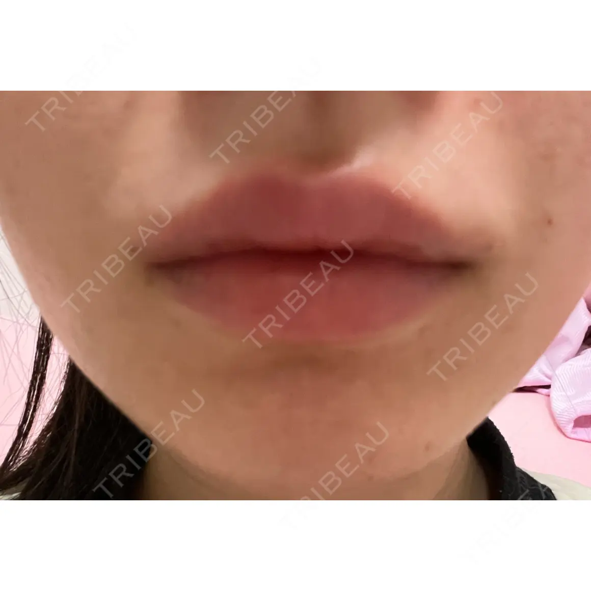ヒアルロン酸注入（唇） / ボトックス（口角） / ボトックス（人中） / ボトックス（ガミースマイル） EMMO FACE CLINIC 大宮院 DAY 0