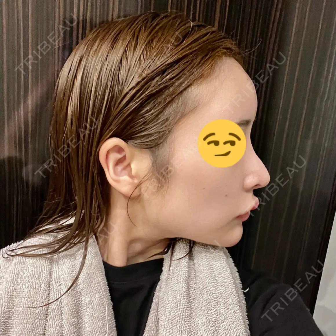 ヒアルロン酸注入（額） APスキンクリニック銀座 DAY 0