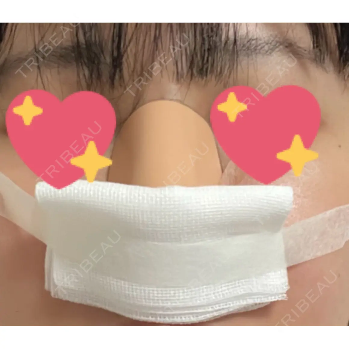 小鼻縮小（切開） Zetith Beauty Clinic 銀座院 DAY 1