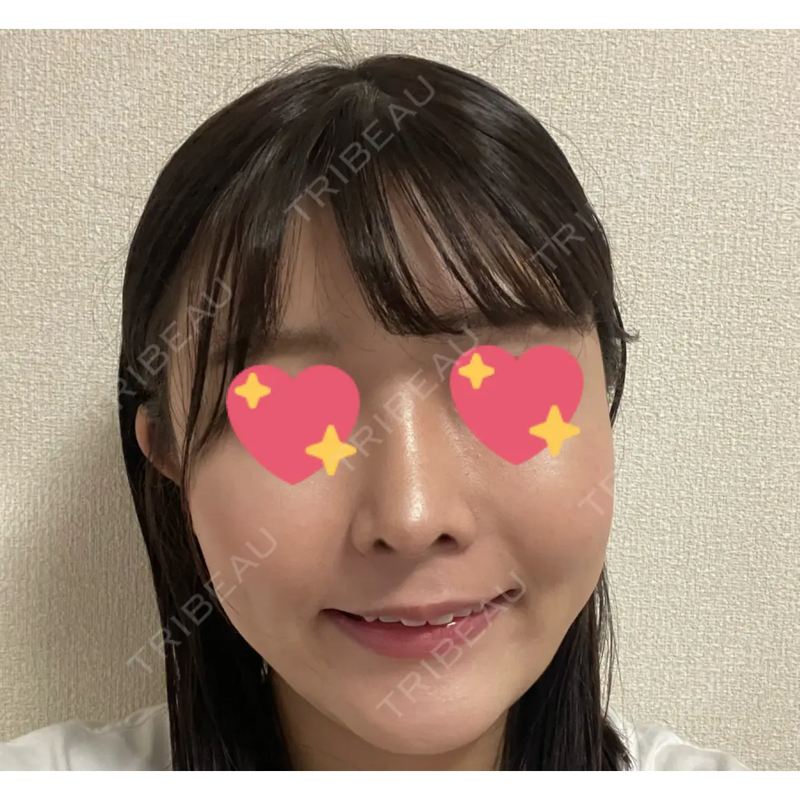 プロテーゼ除去 Zetith Beauty Clinic 銀座院 AFTER