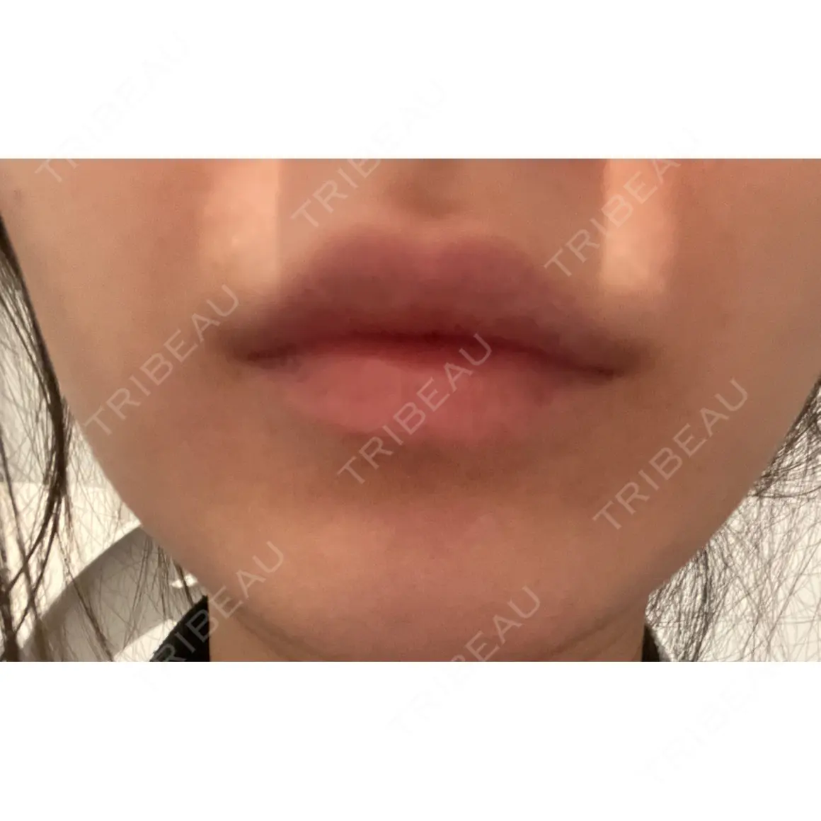 ヒアルロン酸注入（唇） / ボトックス（口角） / ボトックス（人中） / ボトックス（ガミースマイル） EMMO FACE CLINIC 大宮院 AFTER