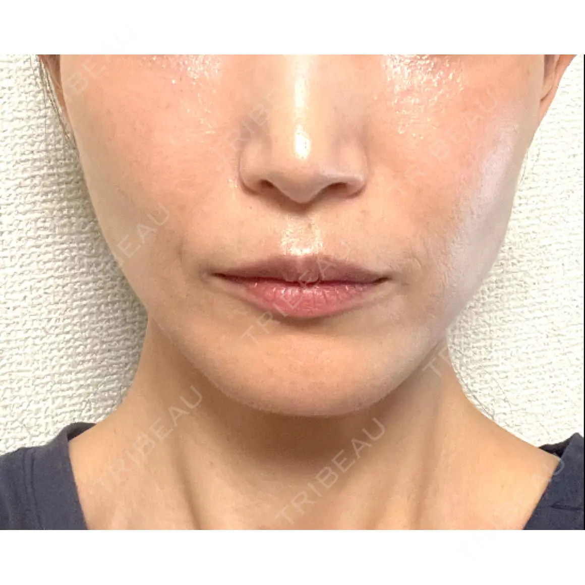 脂肪溶解注射（顔） 東京ロイヤルクリニック AFTER