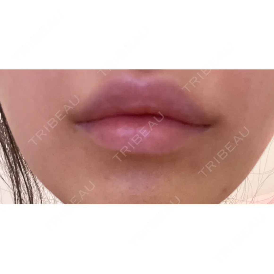ヒアルロン酸注入（唇） / ボトックス（口角） / ボトックス（人中） / ボトックス（ガミースマイル） EMMO FACE CLINIC 大宮院 AFTER