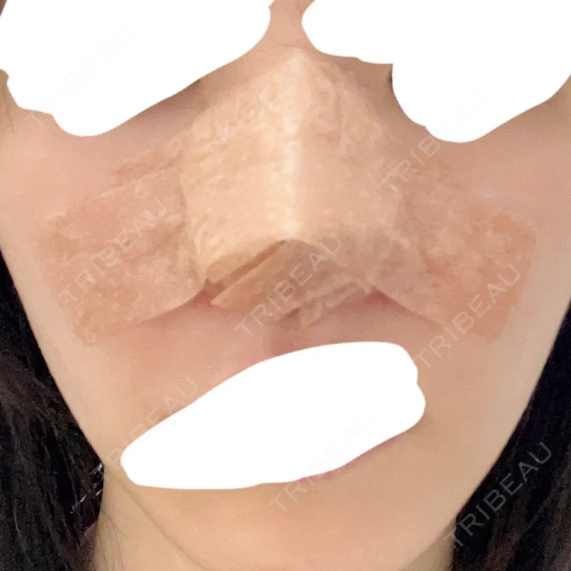 鼻尖形成（切開） / 軟骨移植 / 鼻尖縮小 ASTRA BEAUTY CLINIC DAY 0