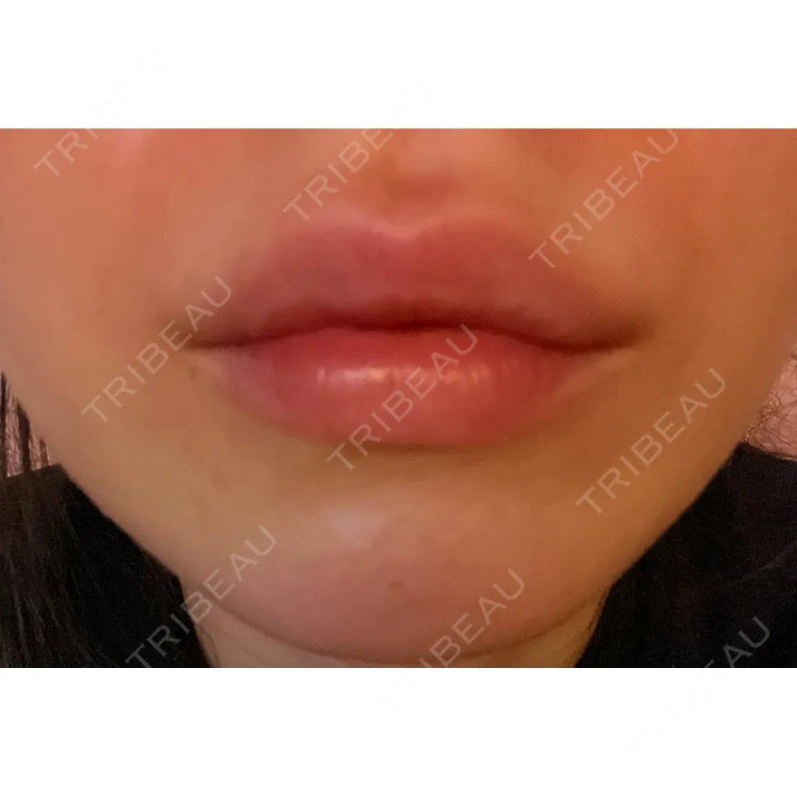 ヒアルロン酸注入（唇） / ボトックス（口角） / ボトックス（人中） / ボトックス（ガミースマイル） EMMO FACE CLINIC 大宮院 AFTER