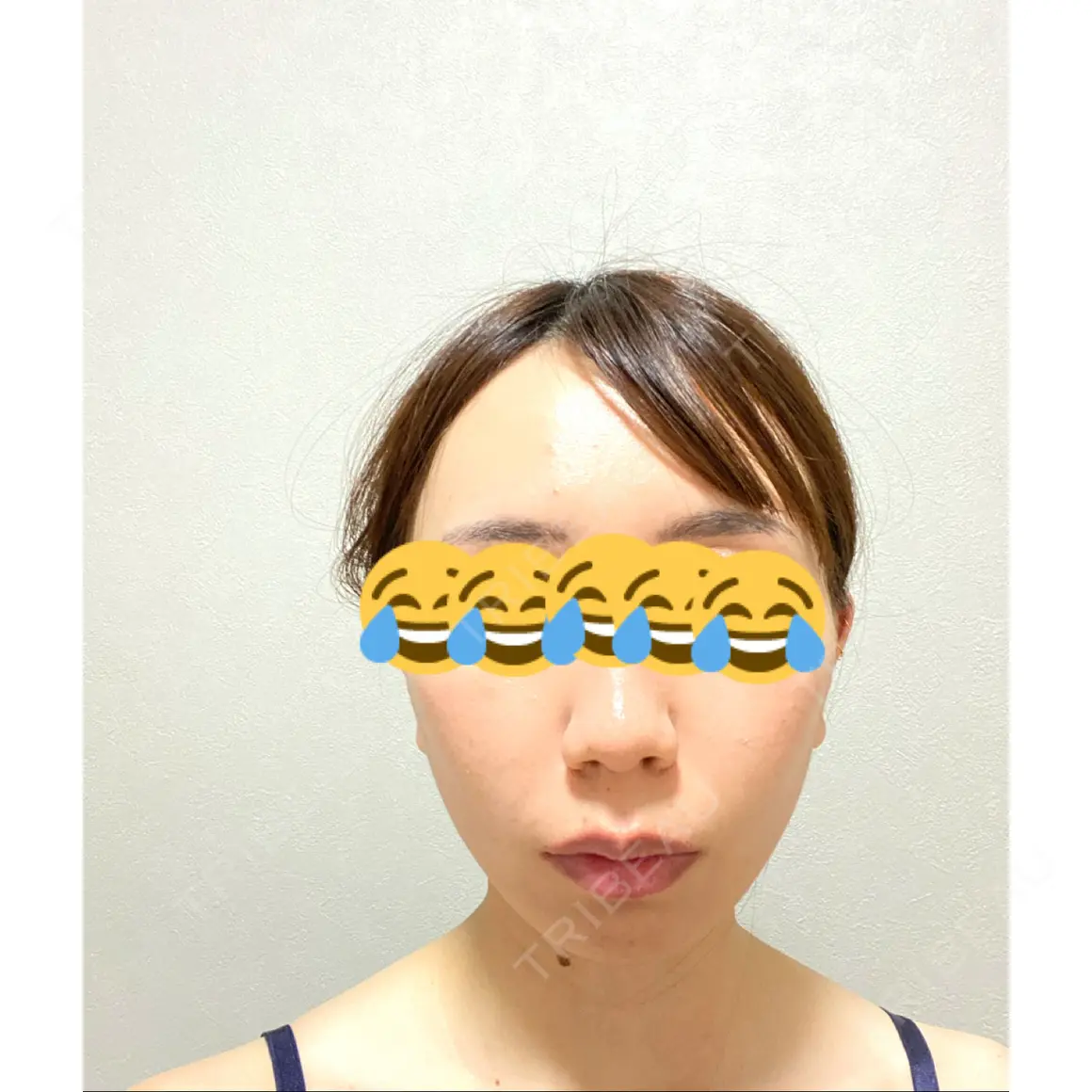 糸リフト 渋谷美容外科クリニック 渋谷院 AFTER