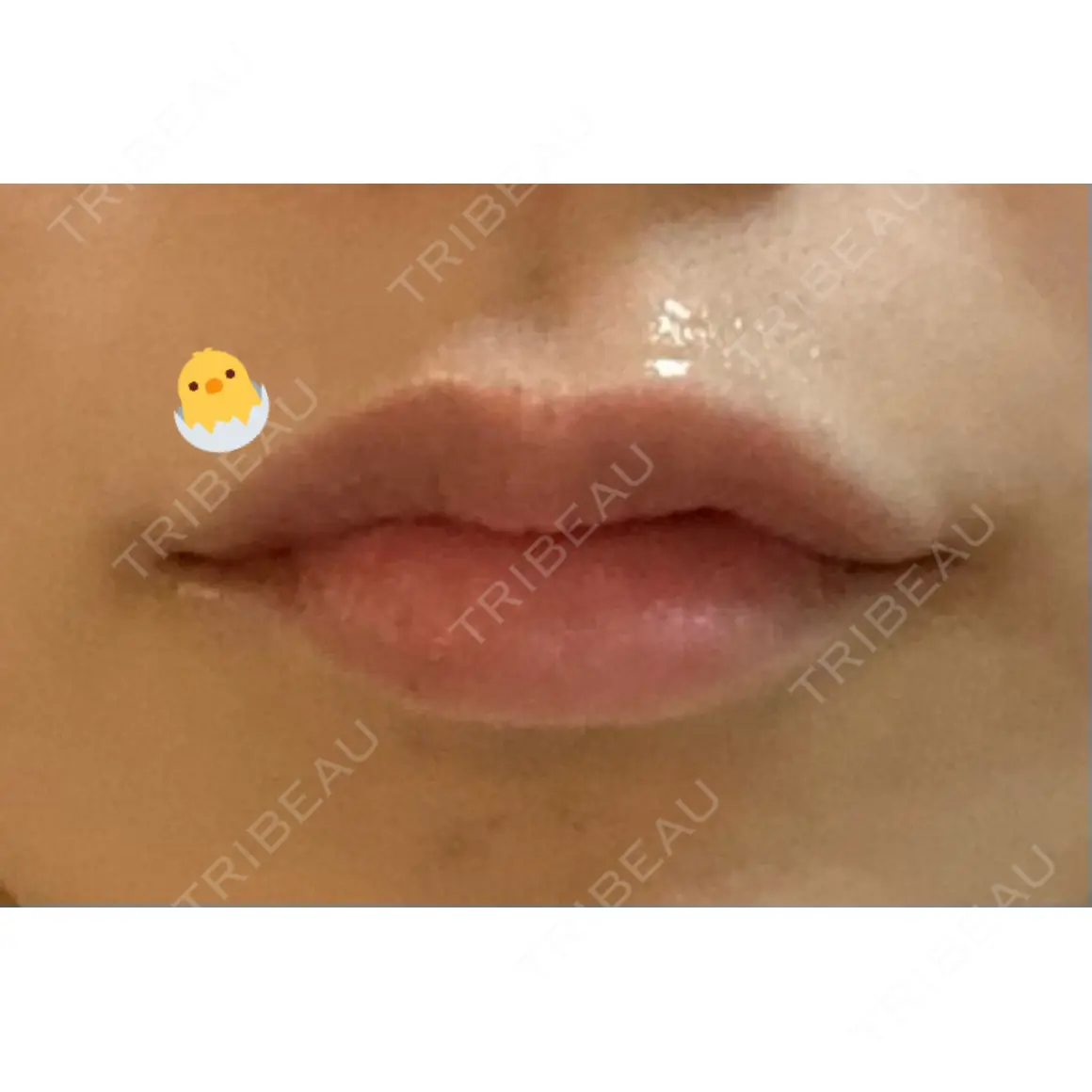 ボトックス（あご） / ボトックス（口角） / ボトックス（肩） / ボトックス（人中） EMMO FACE CLINIC 大宮院 AFTER