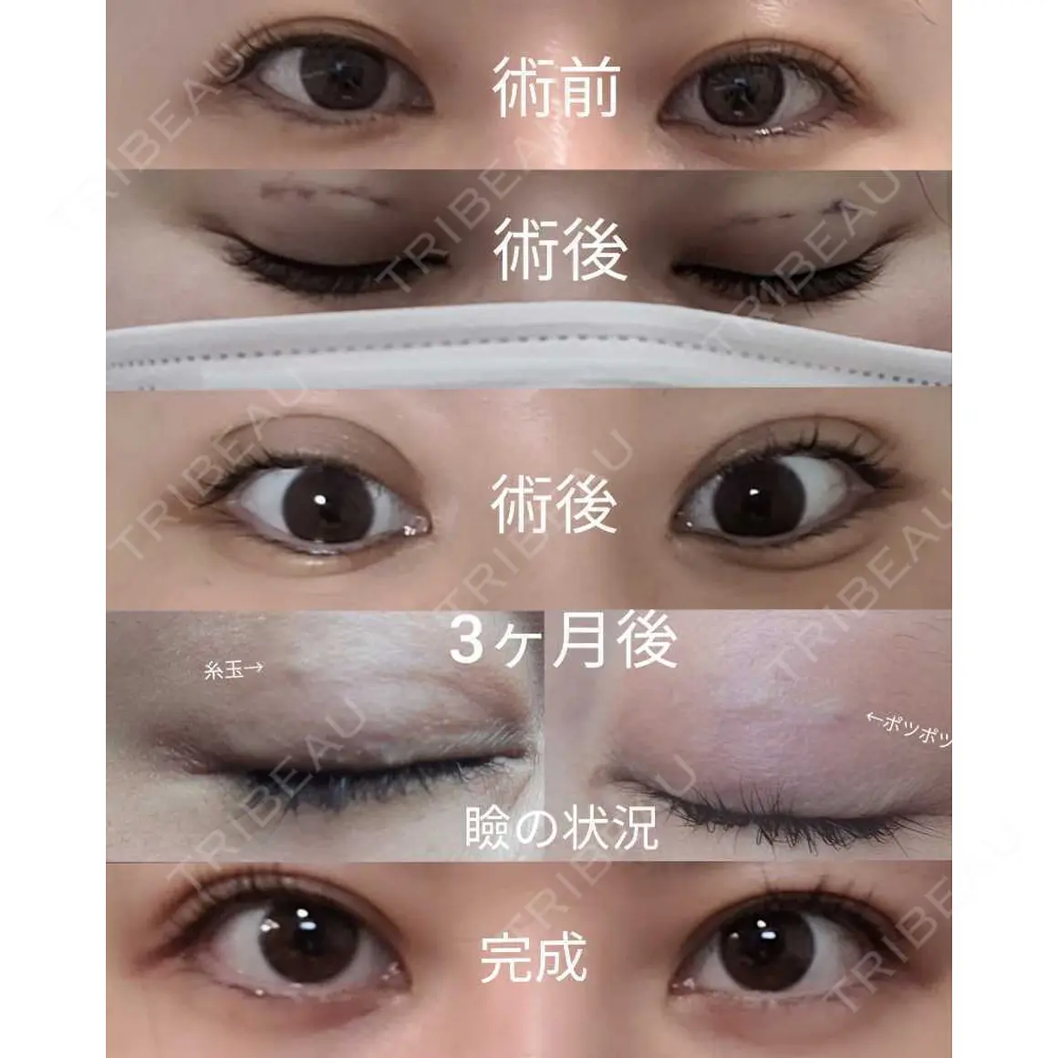 二重埋没 / ほくろ・いぼ切除（肌） / 脂肪吸引（顔） / ジョールファット除去 ブルームクリニック（BLOOM CLINIC） AFTER
