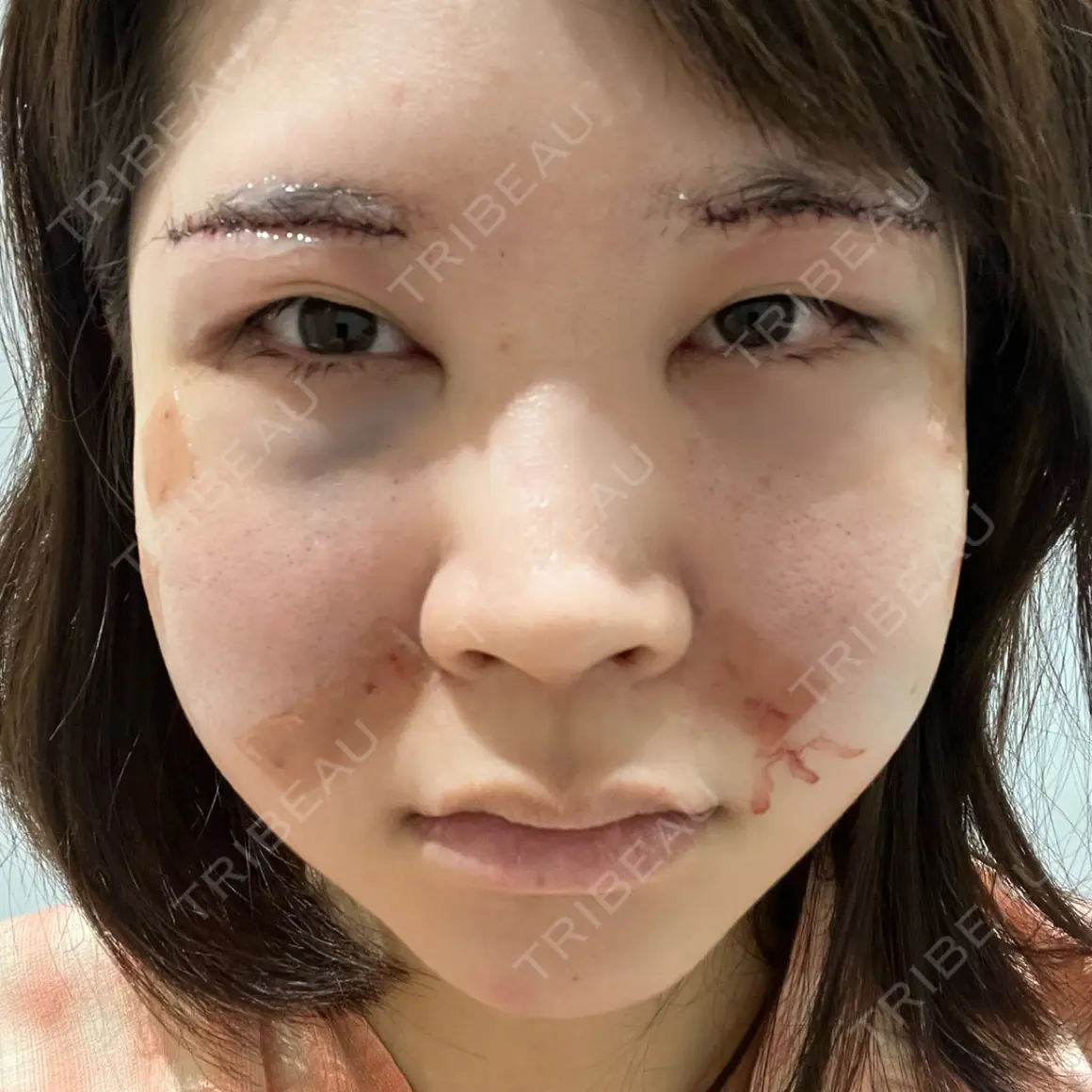 糸リフト / クマ治療 / 眉下切開 / メーラーファット除去 / 脂肪注入（目の下） Otus Clinic 【オータスクリニック】 DAY 0