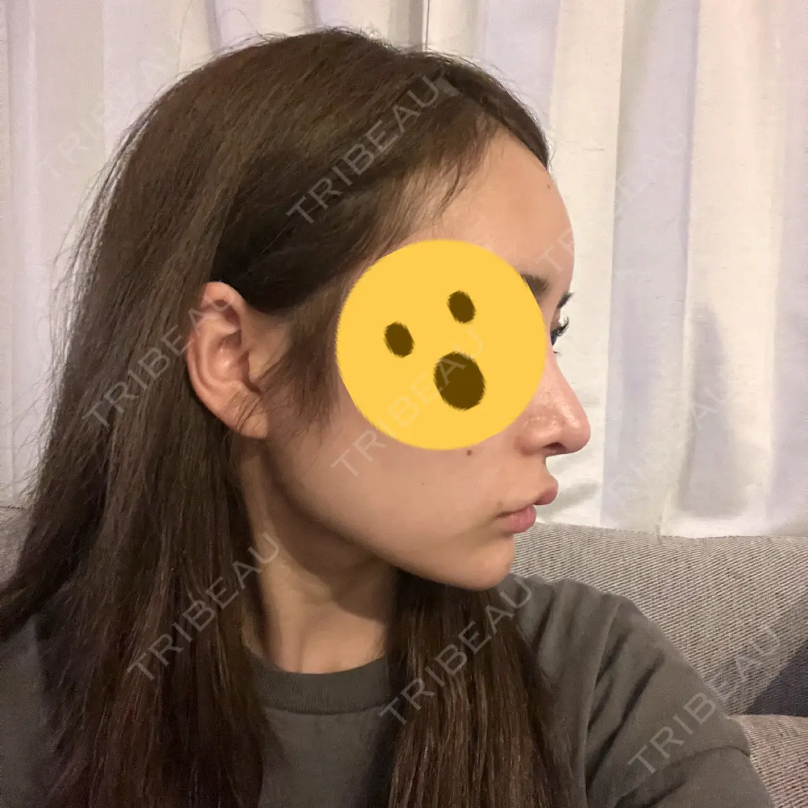 ヒアルロン酸注入（額） APスキンクリニック銀座 AFTER