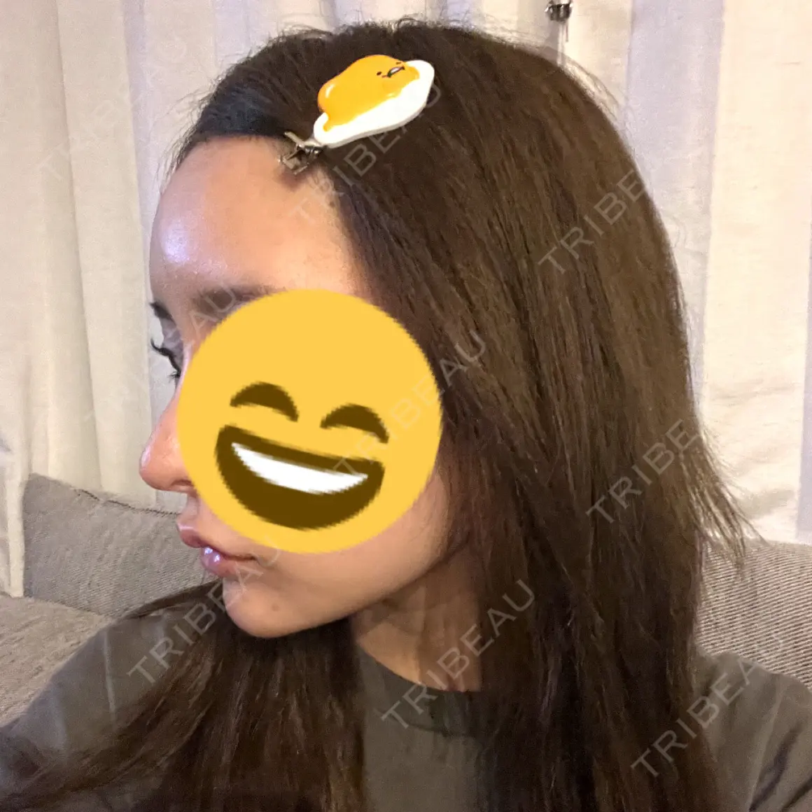 ヒアルロン酸注入（額） APスキンクリニック銀座 AFTER