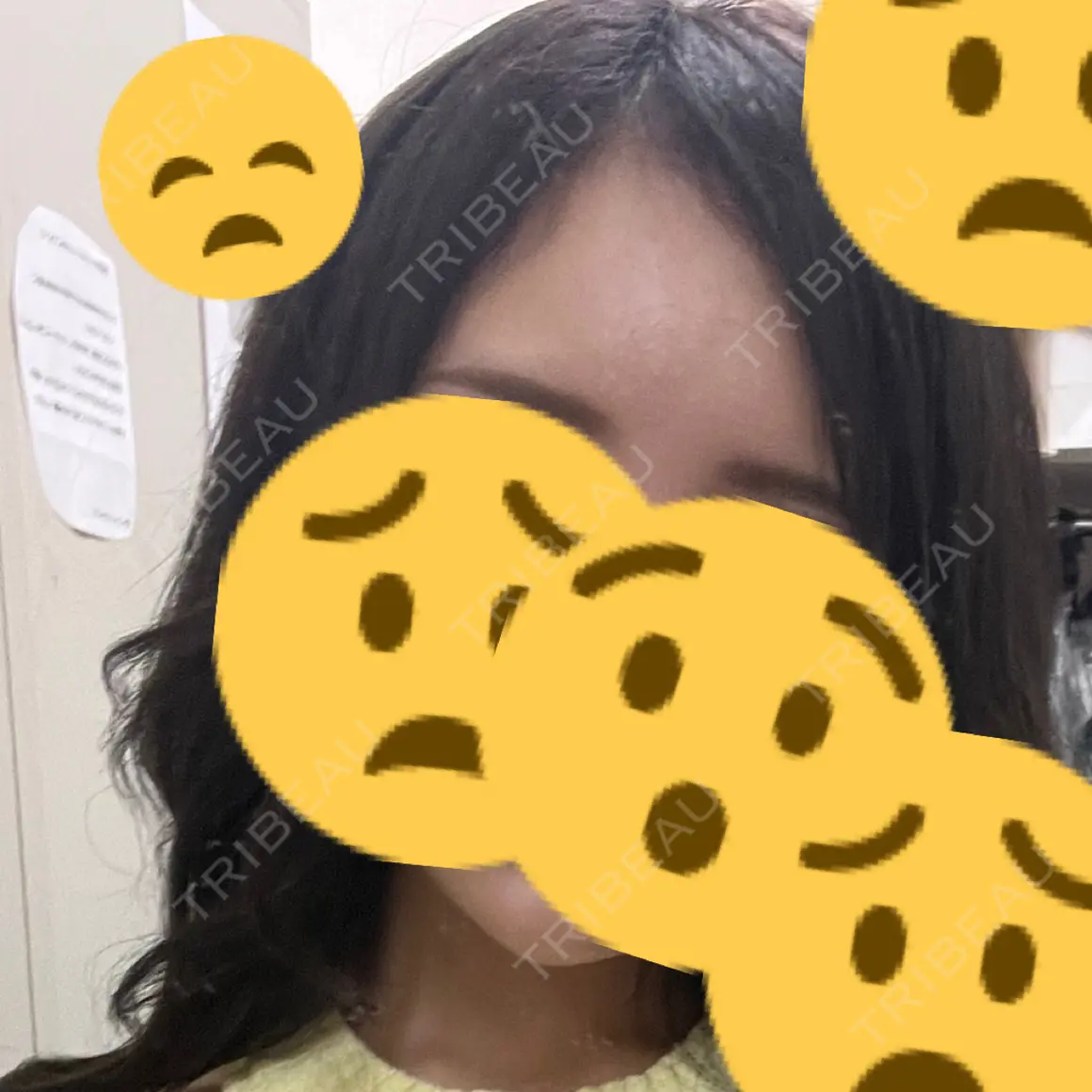 ヒアルロン酸注入（額） APスキンクリニック銀座 AFTER