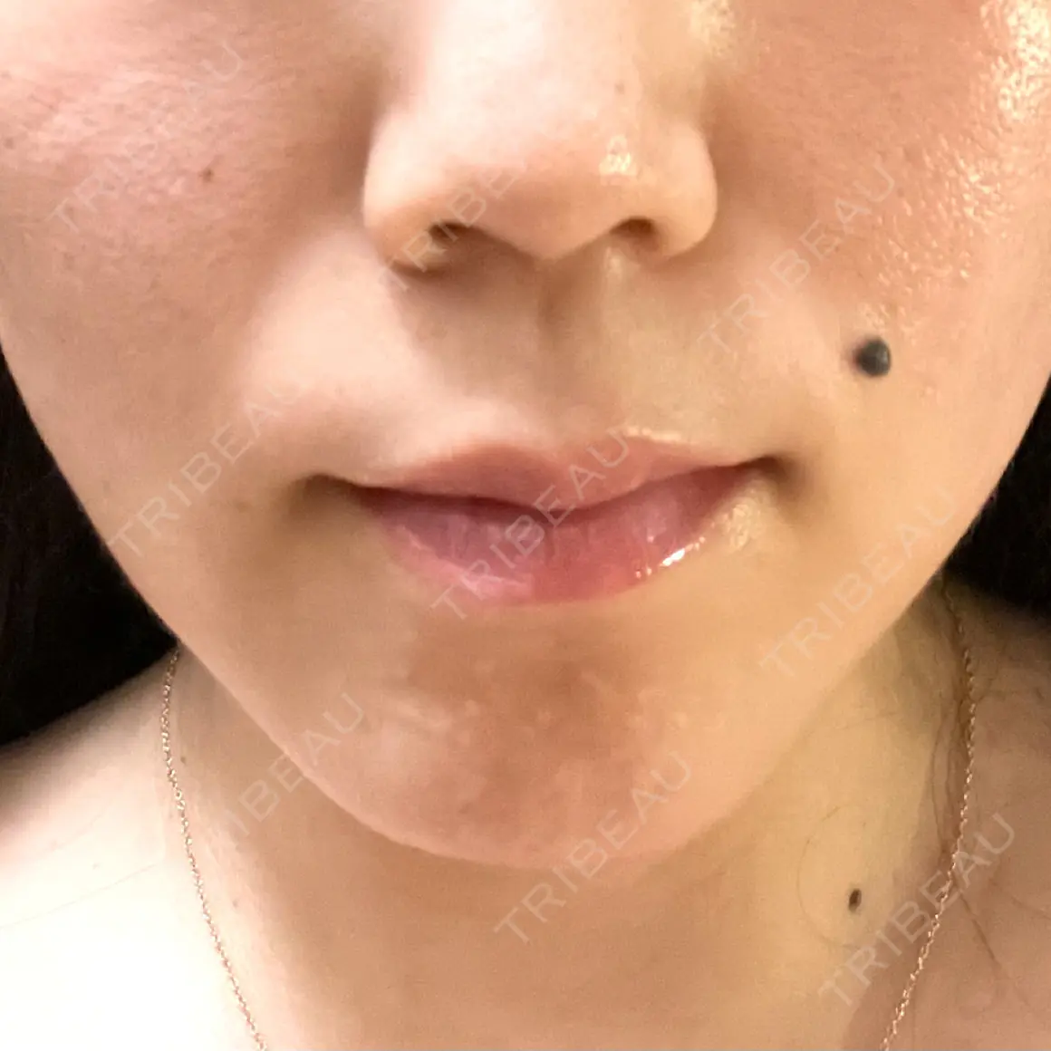 糸リフト ブルームクリニック（BLOOM CLINIC） DAY 0