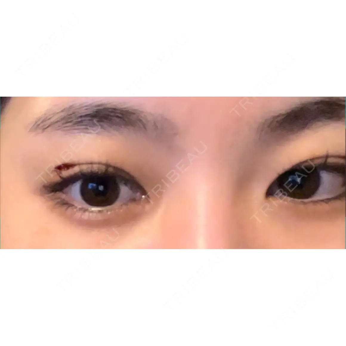 上まぶたの脂肪取り / その他（目元） 9BeautyClinic DAY 0