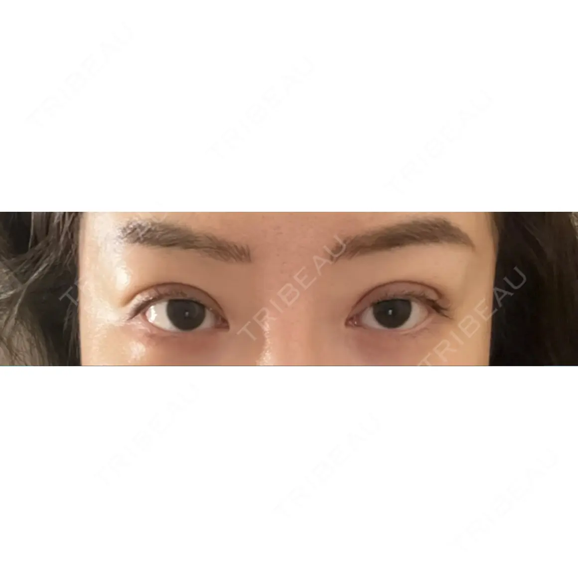 二重埋没 9BeautyClinic AFTER