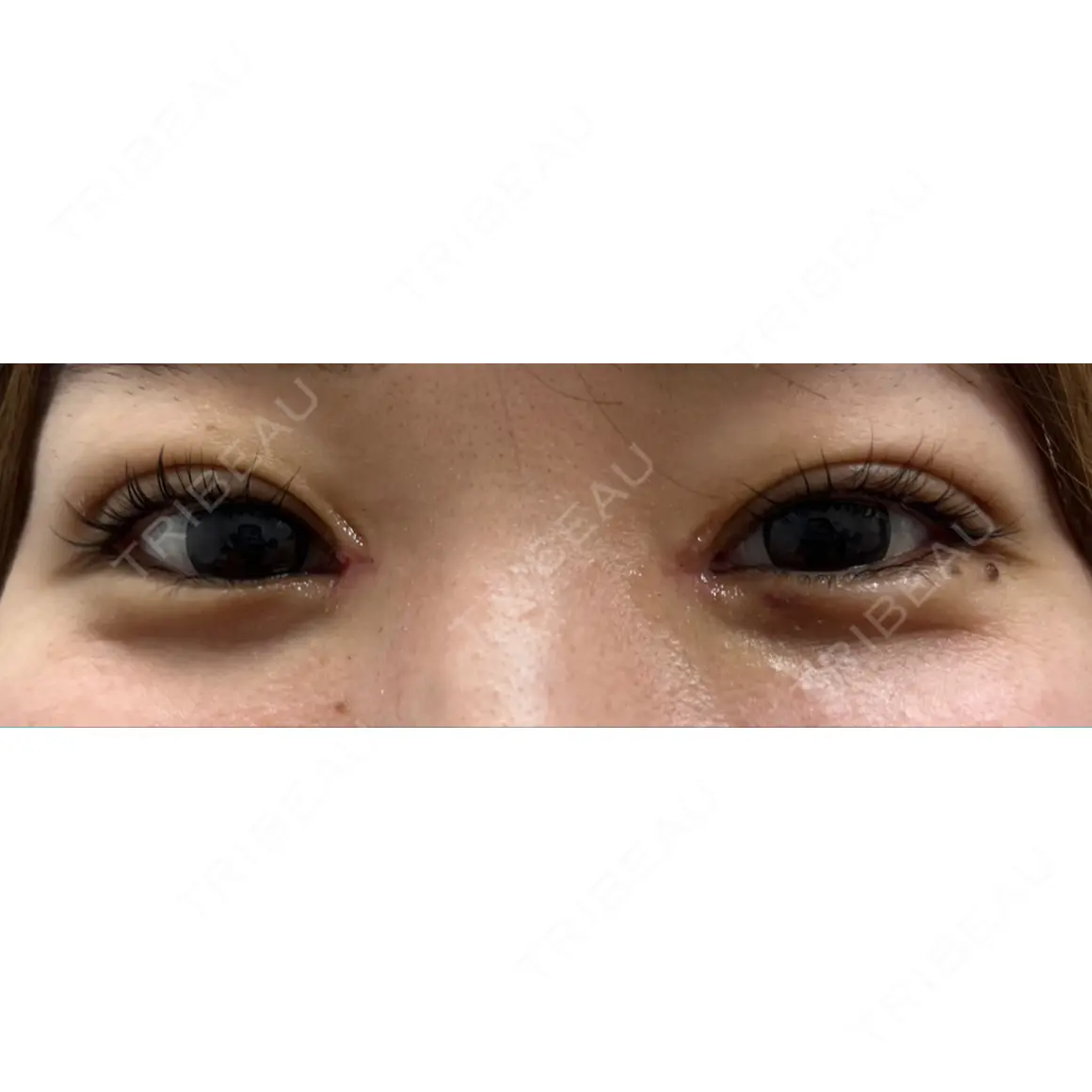 二重埋没 / 目頭切開 9BeautyClinic DAY 5