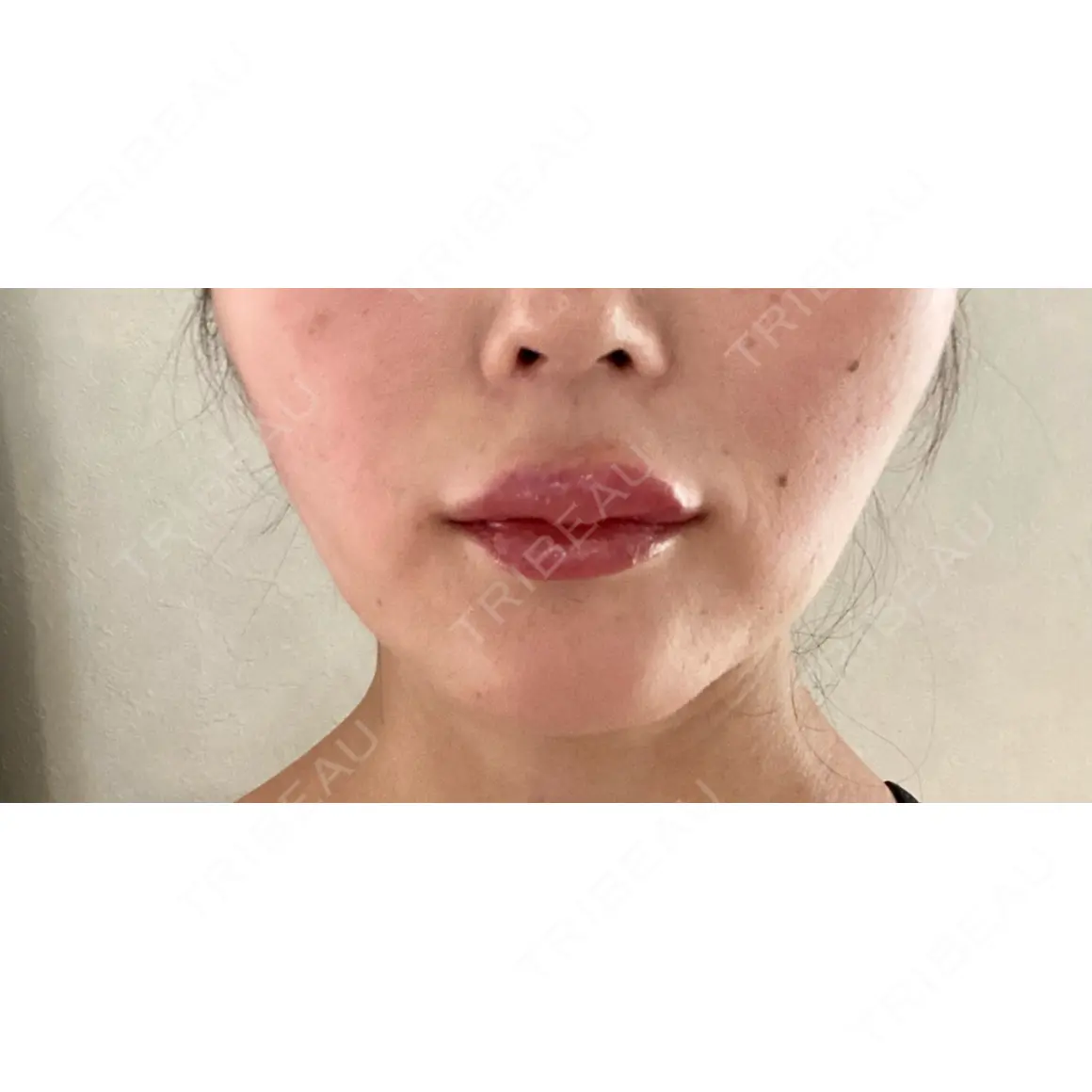 人中短縮 / ヒアルロン酸注入（唇） / ボトックス（口角） DMTC美容皮膚科 日本橋院 AFTER