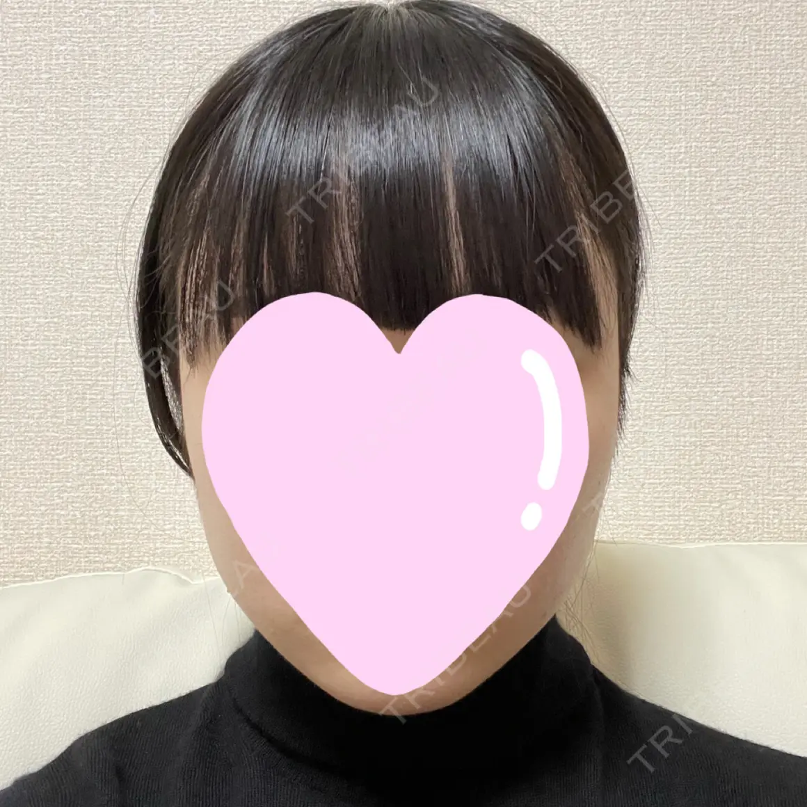 脂肪溶解注射（顔） 東京ロイヤルクリニック AFTER