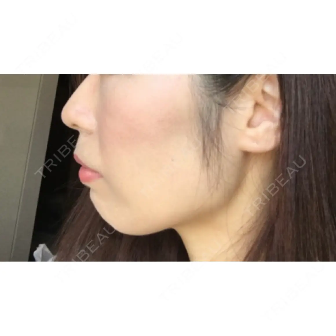 あごプロテーゼ / 鼻翼基部形成（貴族手術） ジョウクリニック 大阪院 AFTER