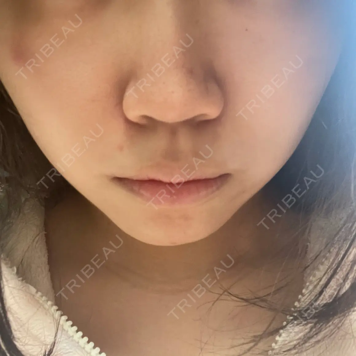 隆鼻術 / 鼻尖形成（切開） / 鼻中隔延長（切開） / 小鼻縮小（切開） / 軟骨移植 グローバルビューティークリニック 大阪院 AFTER