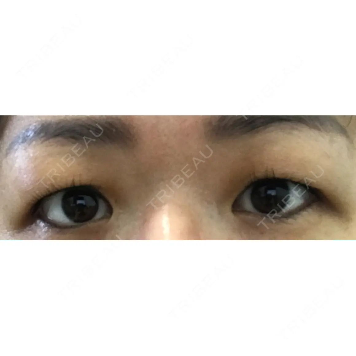 眉下切開 湘南美容クリニック 大阪京橋院 AFTER