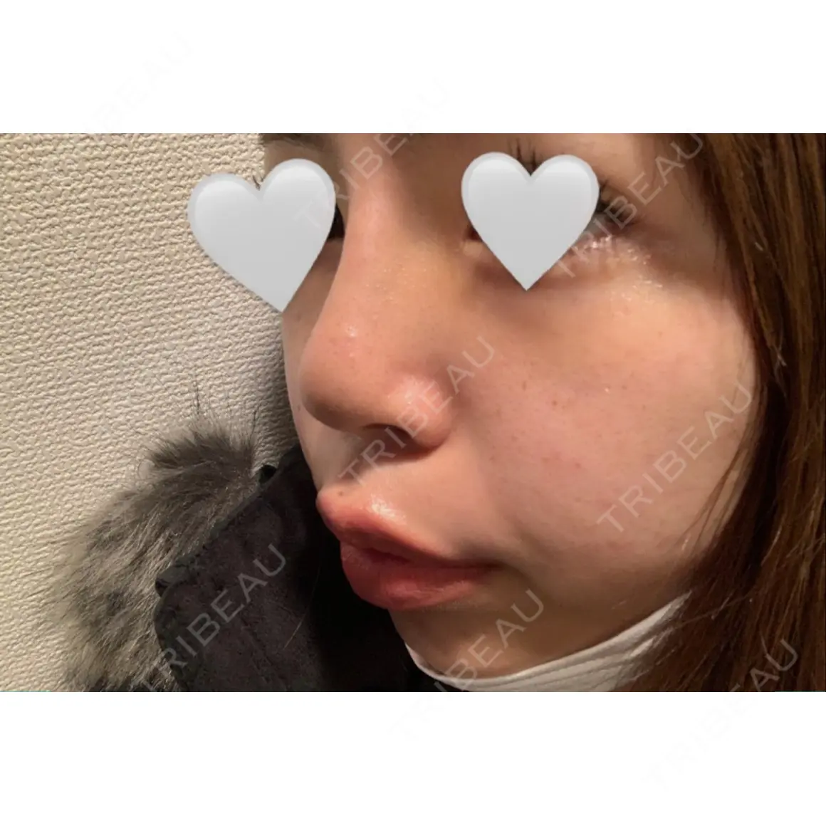 鼻尖形成（切開） / 軟骨移植 / 鼻修正 MIL CLINIC OSAKA AFTER