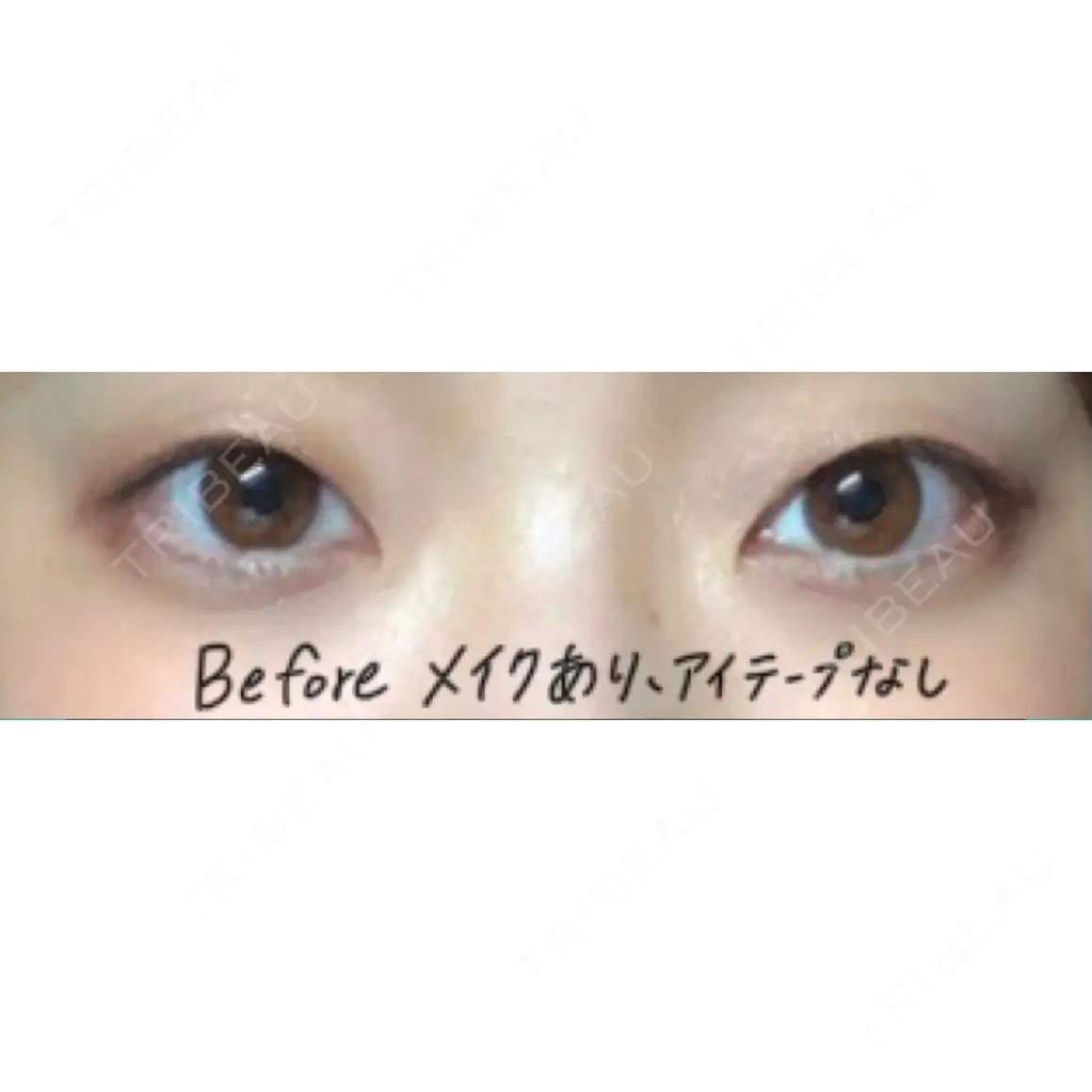 二重埋没 湘南美容クリニック 新宿本院 AFTER