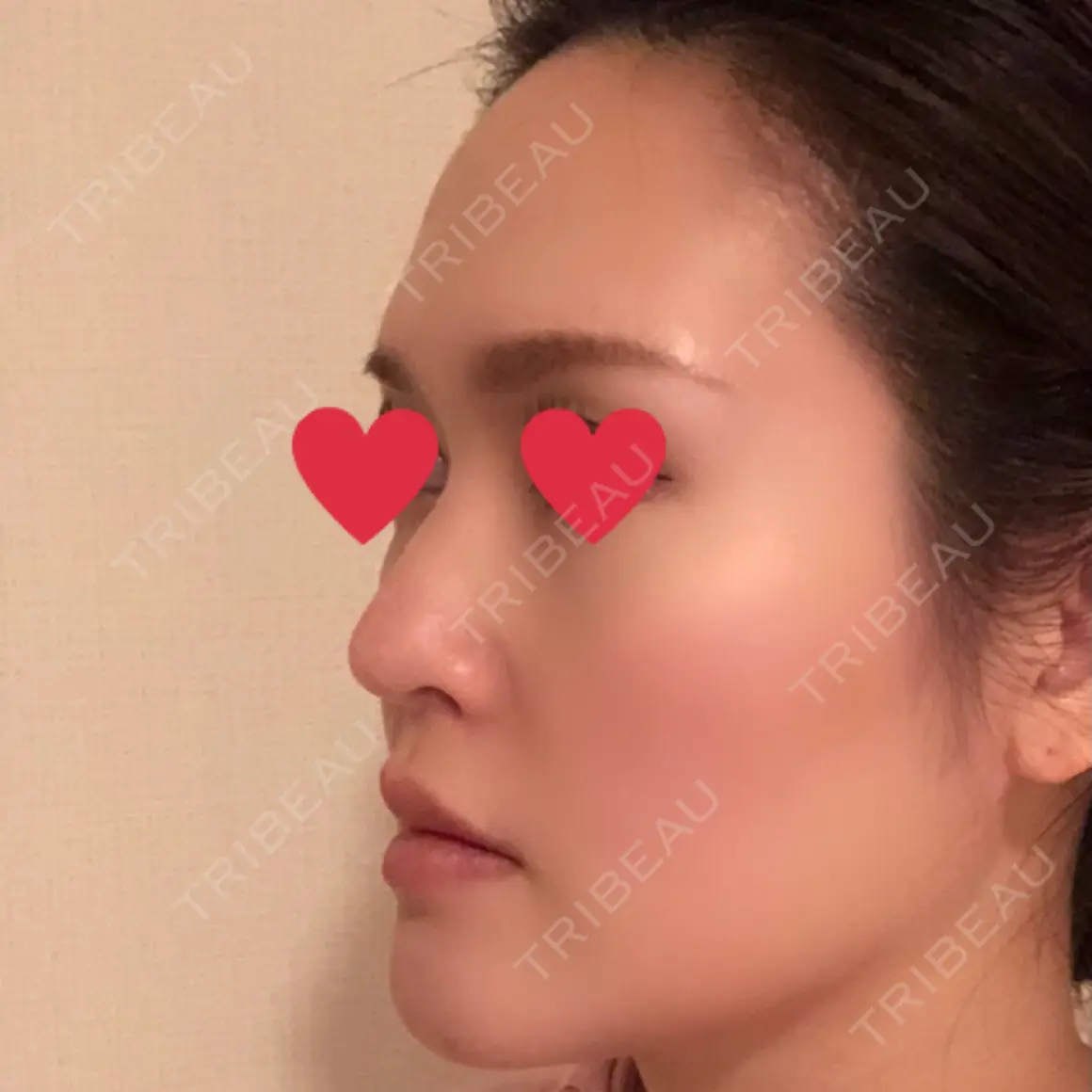 鼻尖形成（切開） / 鼻中隔延長（切開） / 小鼻縮小（切開） / 軟骨移植 / 鼻翼基部形成（貴族手術） AiZ CLINIC AFTER