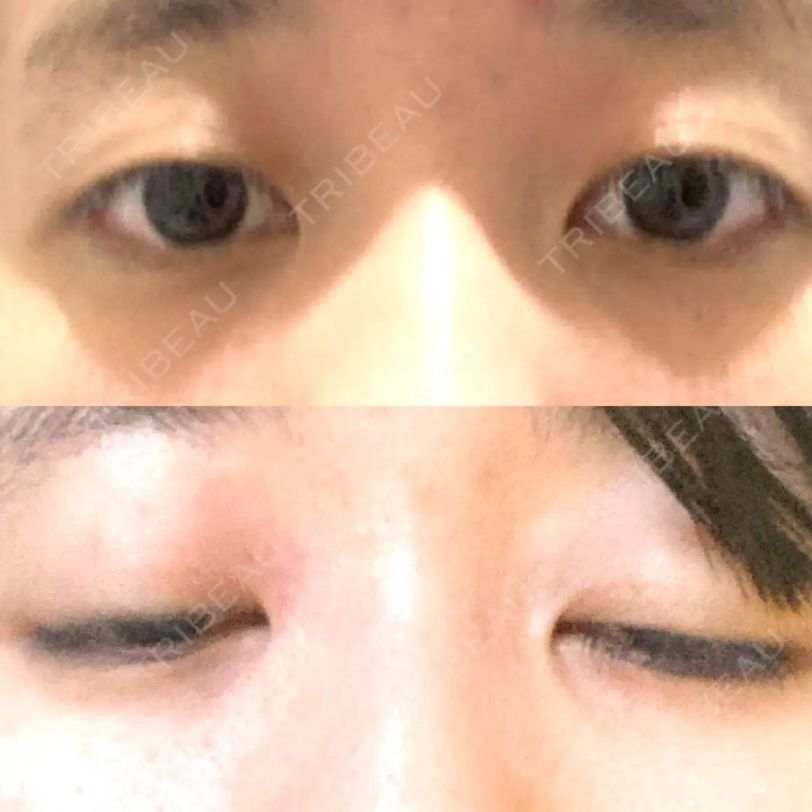二重埋没 / 骨切り（あご） / バッカルファット除去 / 脂肪吸引（顔） / セットバック / ダーマペン アーククリニック AFTER