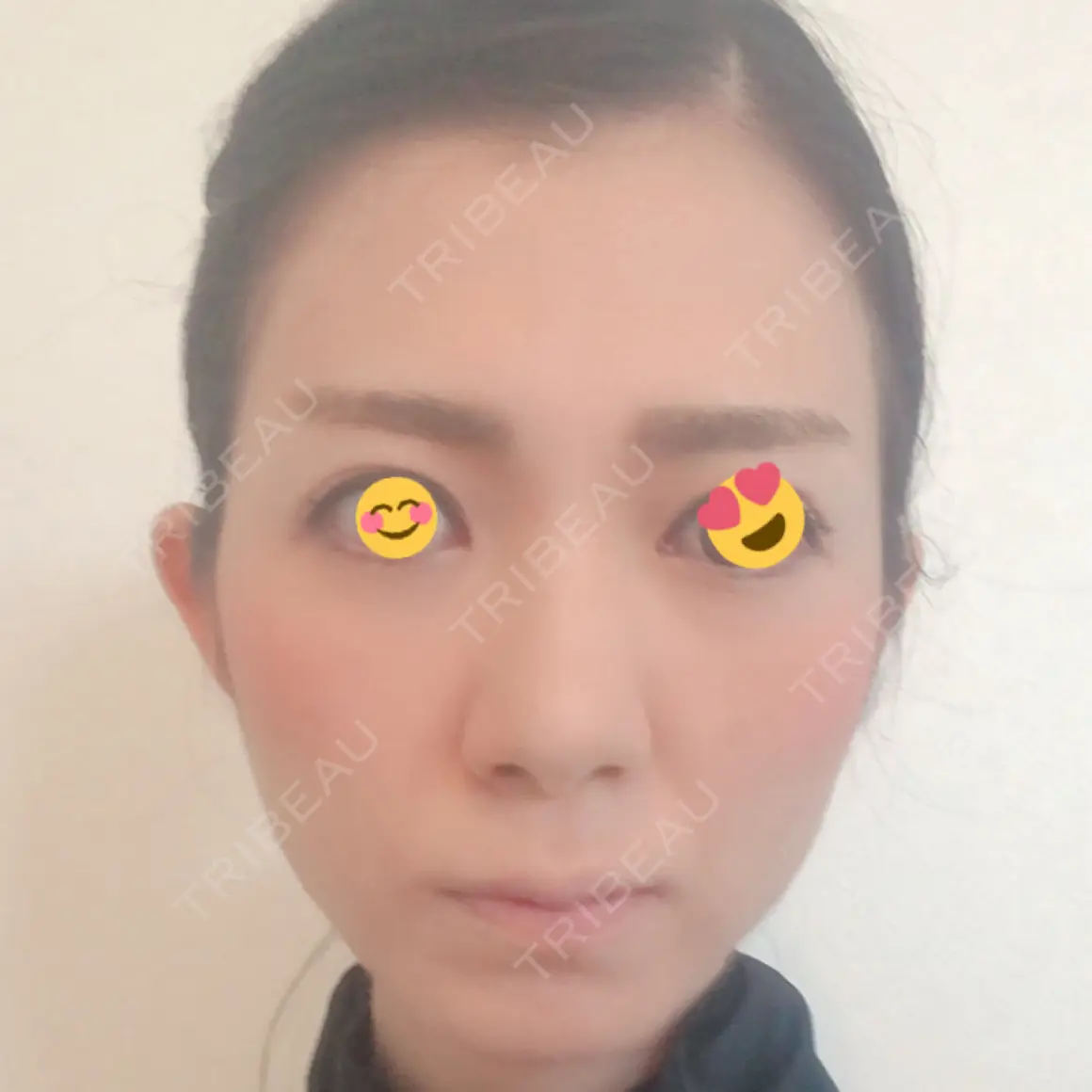 額を丸く / 脂肪注入（肌） / こめかみ形成 / 脂肪注入（額） 湘南美容クリニック 浜松院 AFTER