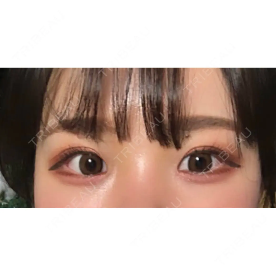 二重埋没 / 目頭切開 TCB東京中央美容外科 新宿東口院 AFTER