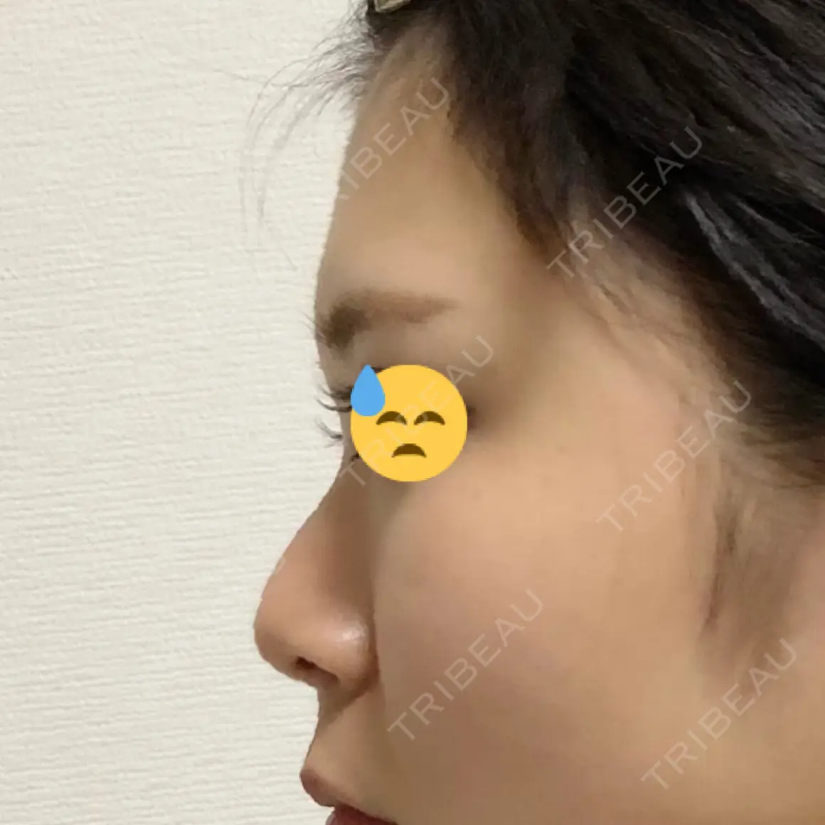 軟骨移植 フェアクリニック川口 AFTER