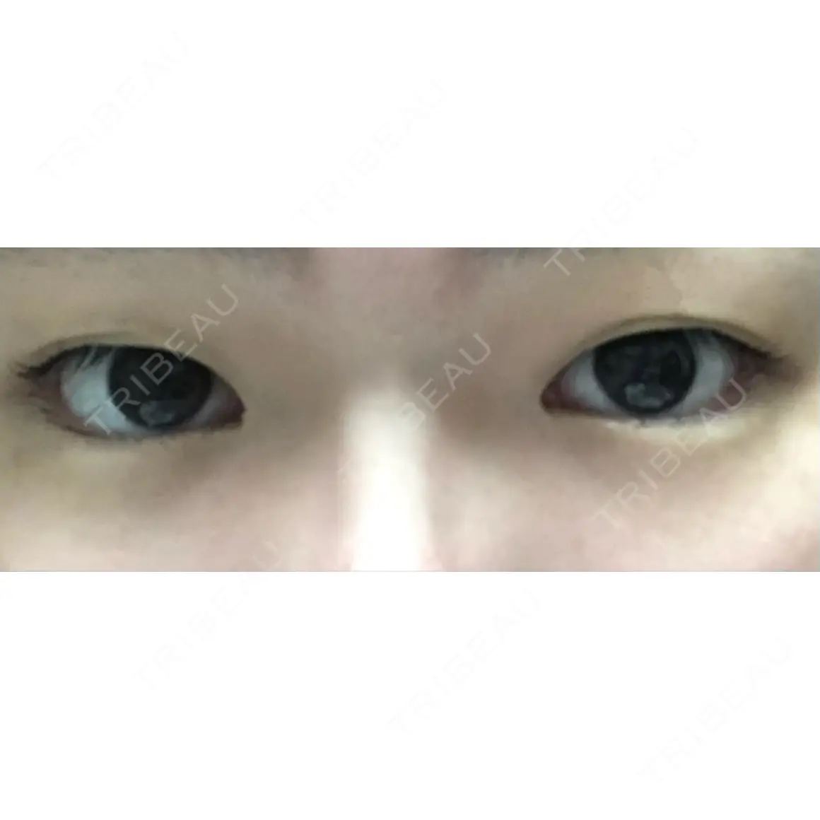 目頭切開 / 眼瞼下垂（切開） / 目尻切開 / 上まぶたの脂肪取り / タレ目形成・グラマラスライン（切開） BIANCA銀座 AFTER