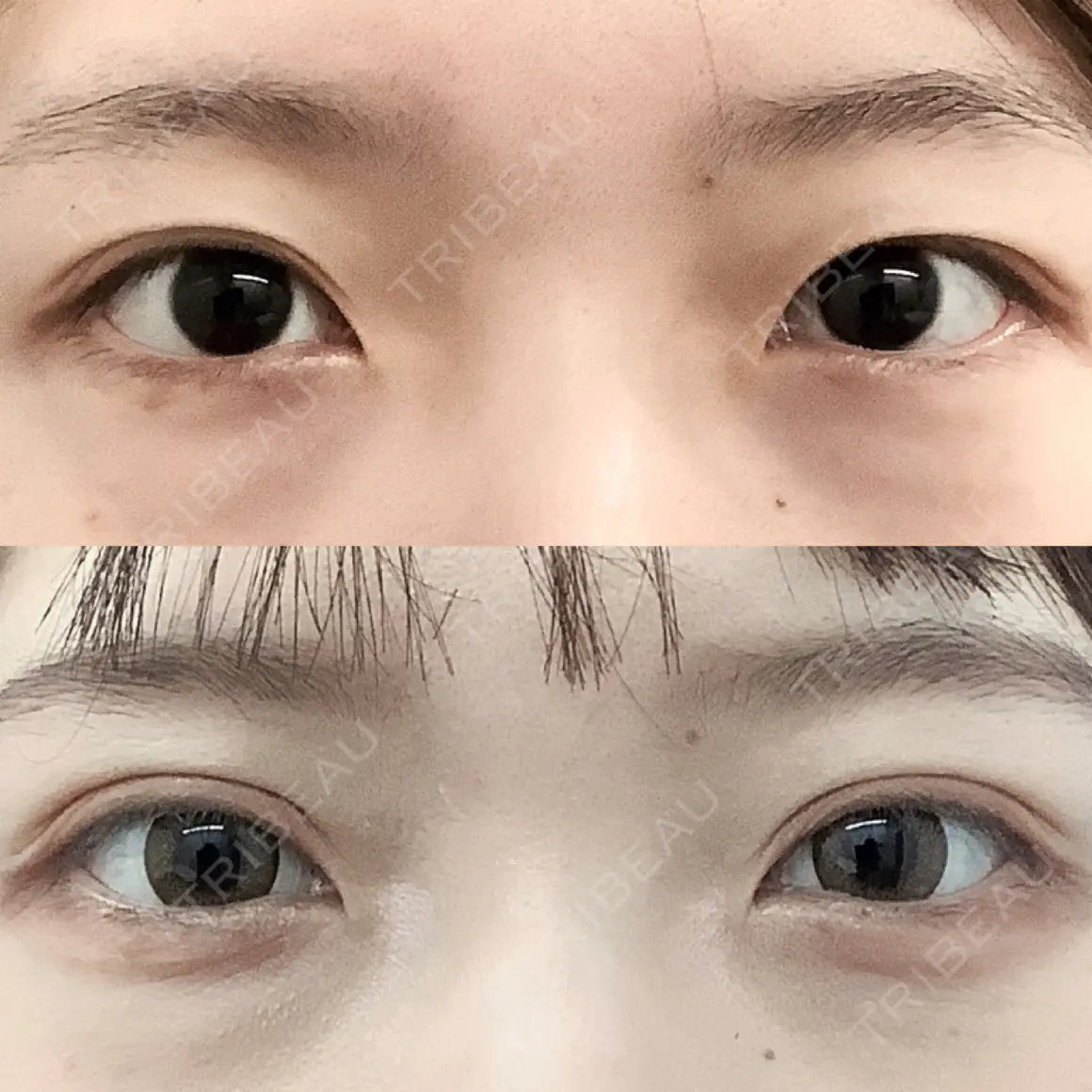 二重埋没 MIL CLINIC OSAKA AFTER