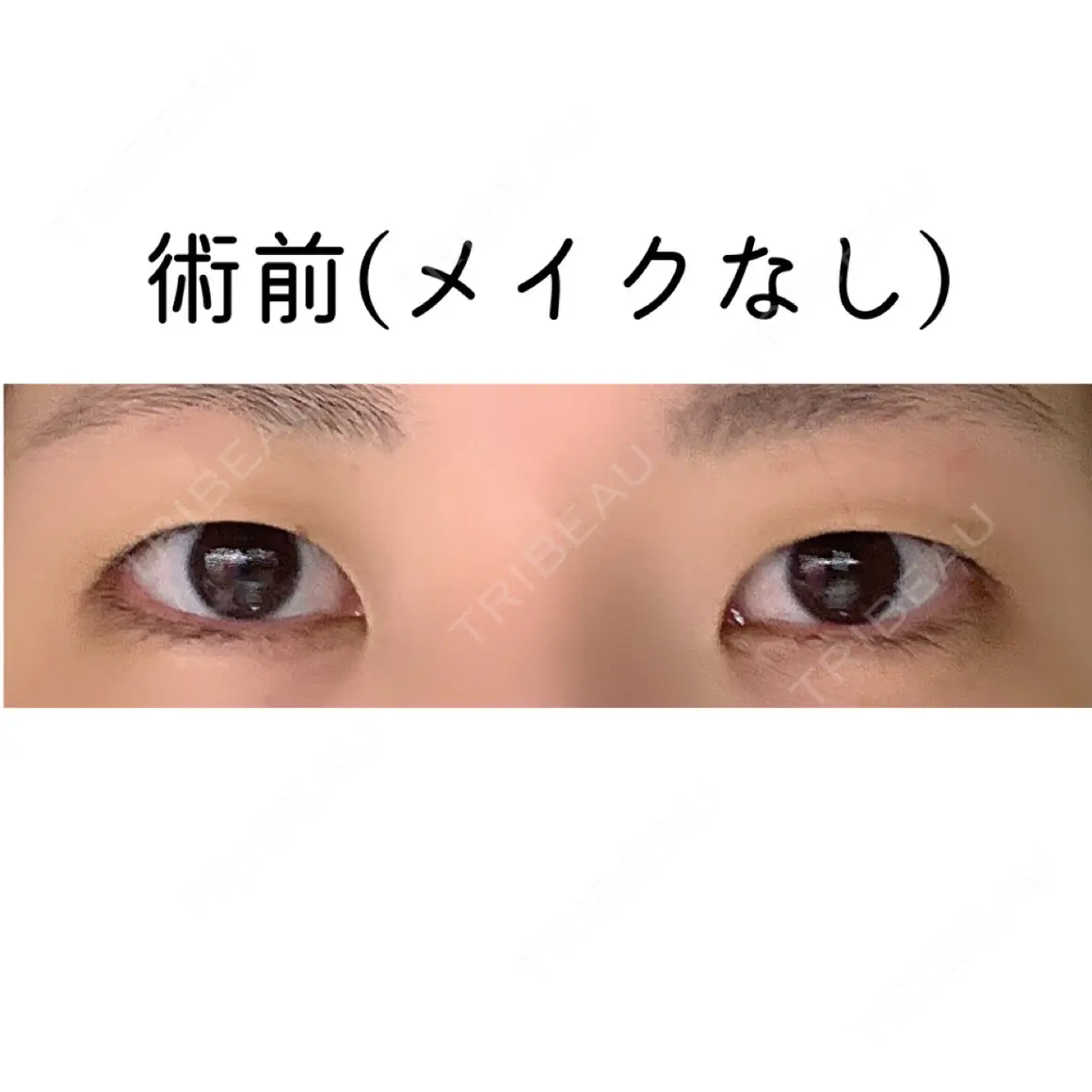 二重埋没 アーティスクリニック 西宮 AFTER