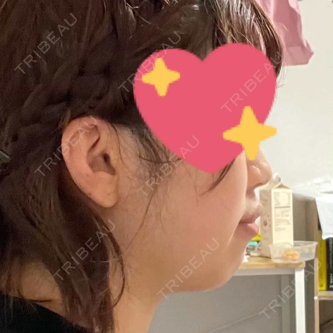 隆鼻術 / 鼻尖形成（切開） / 小鼻縮小（切開） / 軟骨移植 グローバルビューティークリニック 大阪院 AFTER