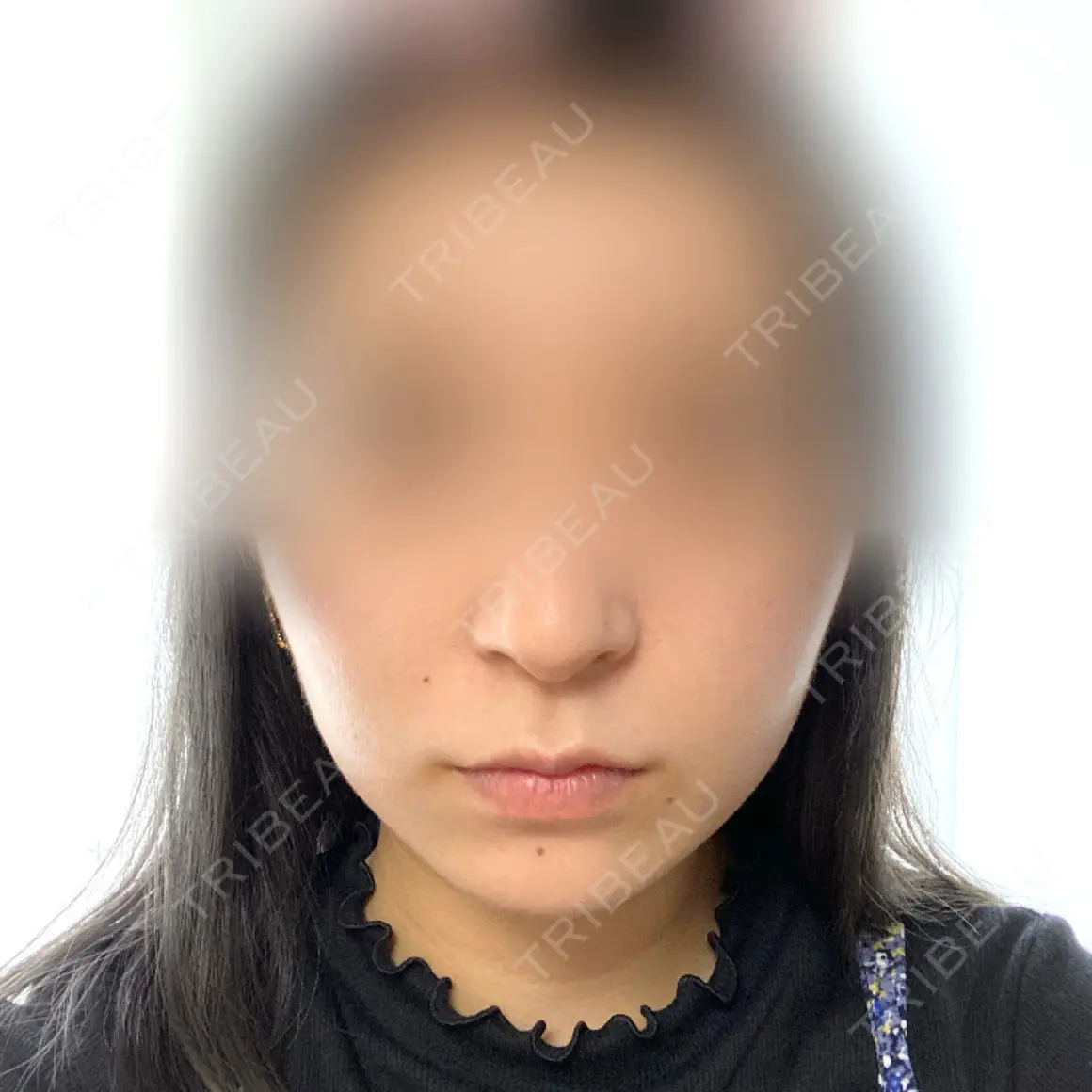ヒアルロン酸注入（あご） / 脂肪溶解注射（顔） id美容クリニック 銀座院 AFTER