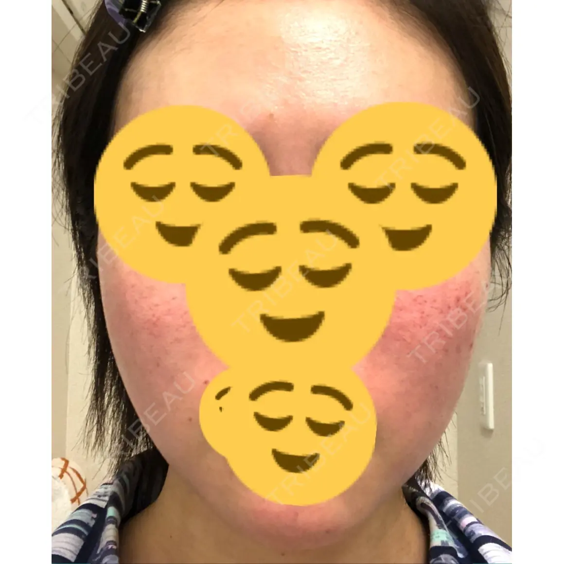 脂肪吸引（顔） Mods Clinic（モッズクリニック） 東京院 AFTER
