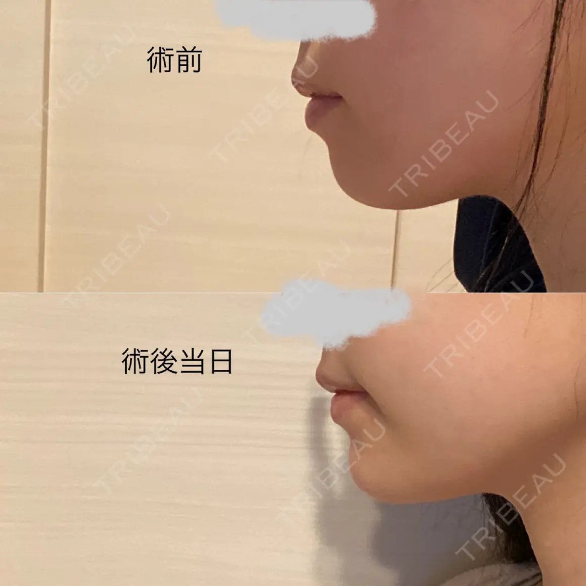 ヒアルロン酸注入（あご） id美容クリニック 銀座院 AFTER