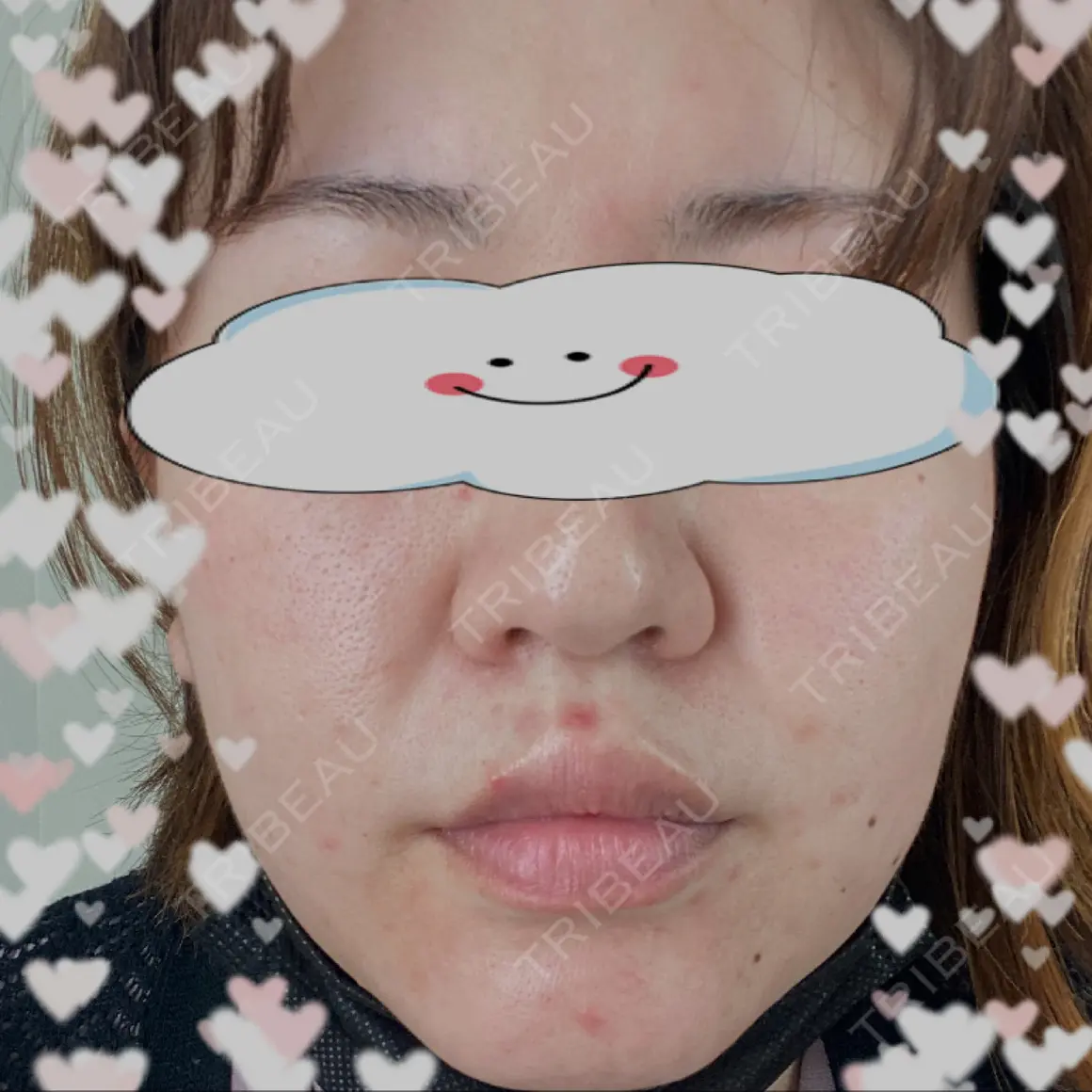 ダーマペン y's clinic  AFTER