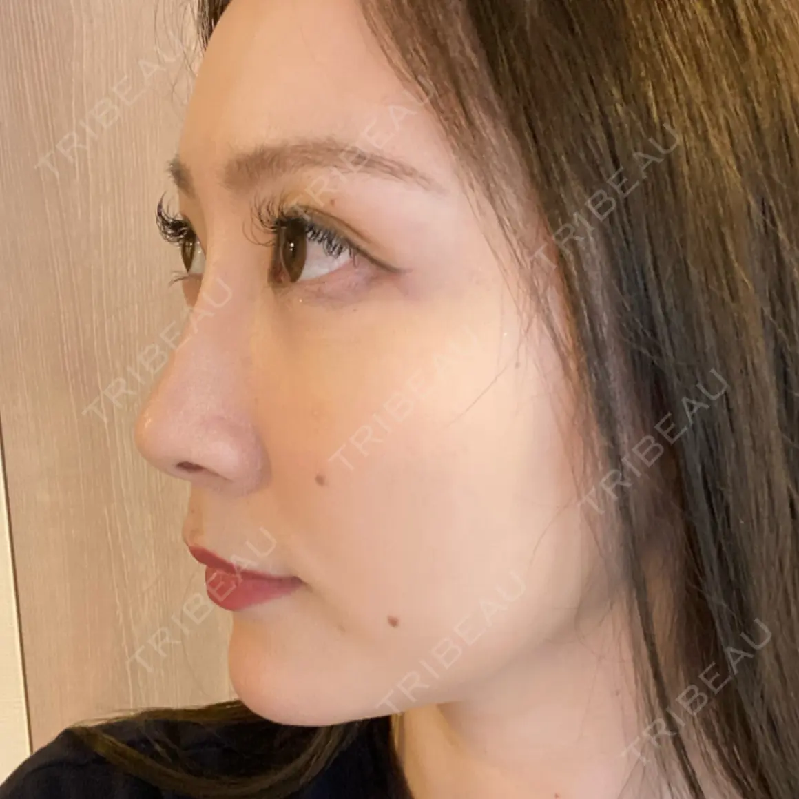 ヒアルロン酸注入（鼻） BIANCA銀座 AFTER