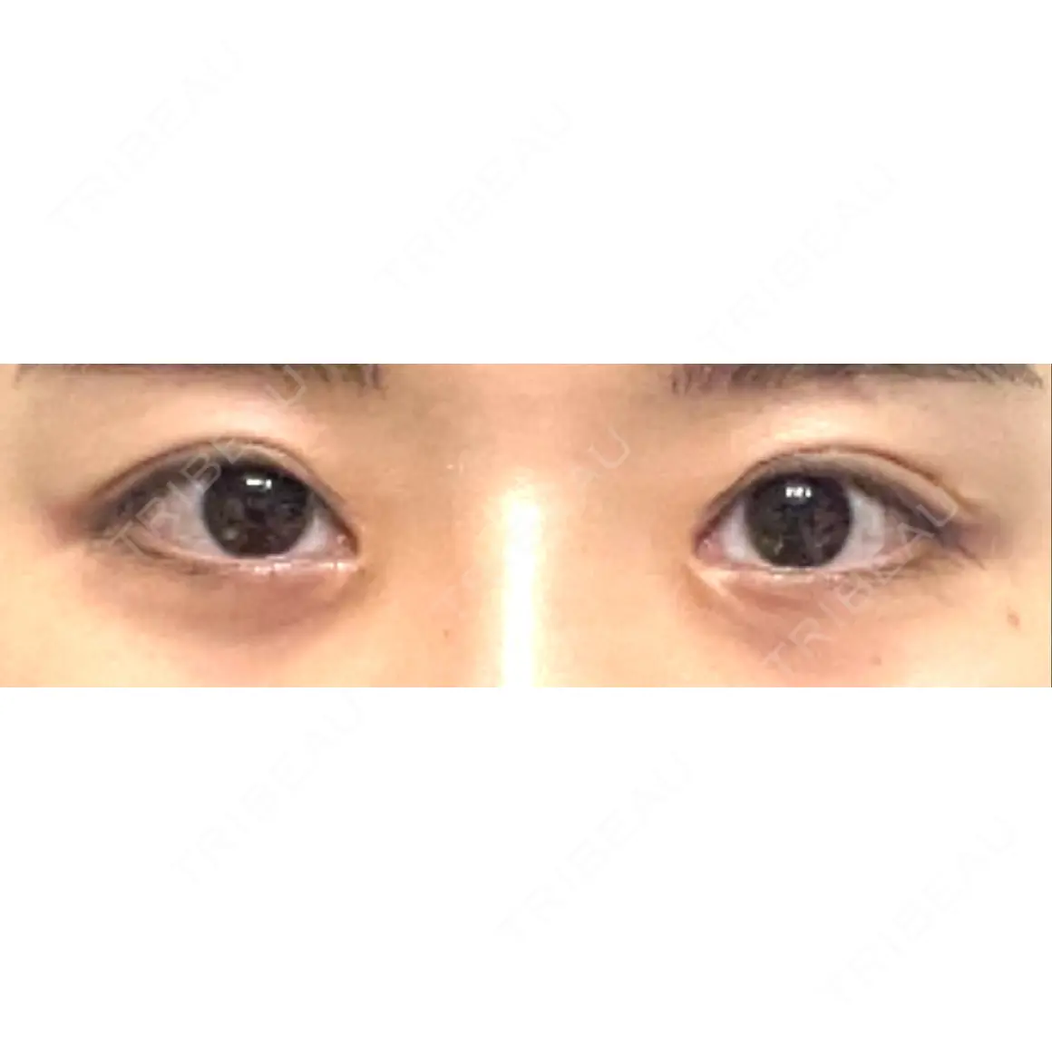 二重切開 / 目元修正 JUN CLINIC AFTER