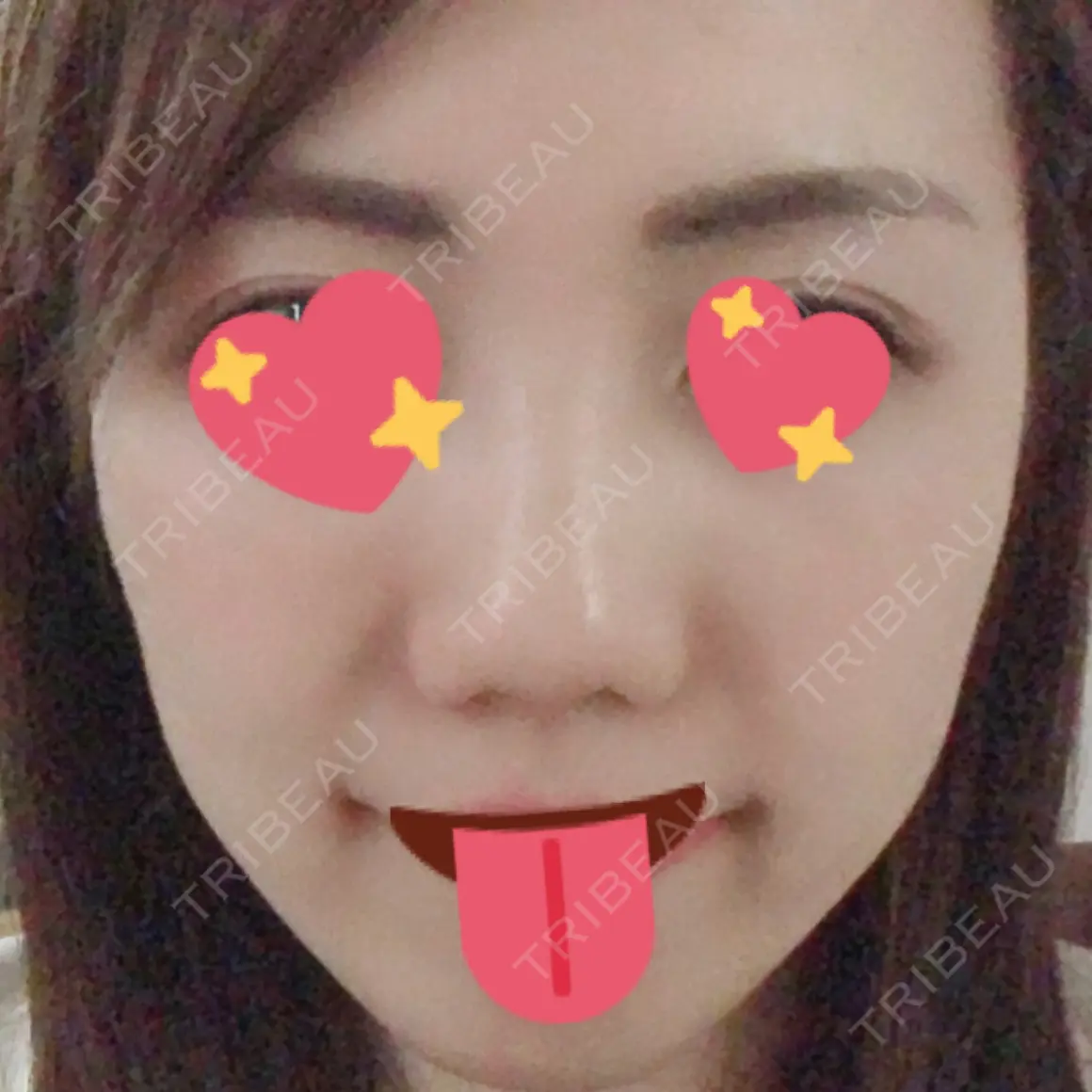 隆鼻術 / 鼻尖形成（切開） / 鼻中隔延長（切開） MIL CLINIC OSAKA AFTER