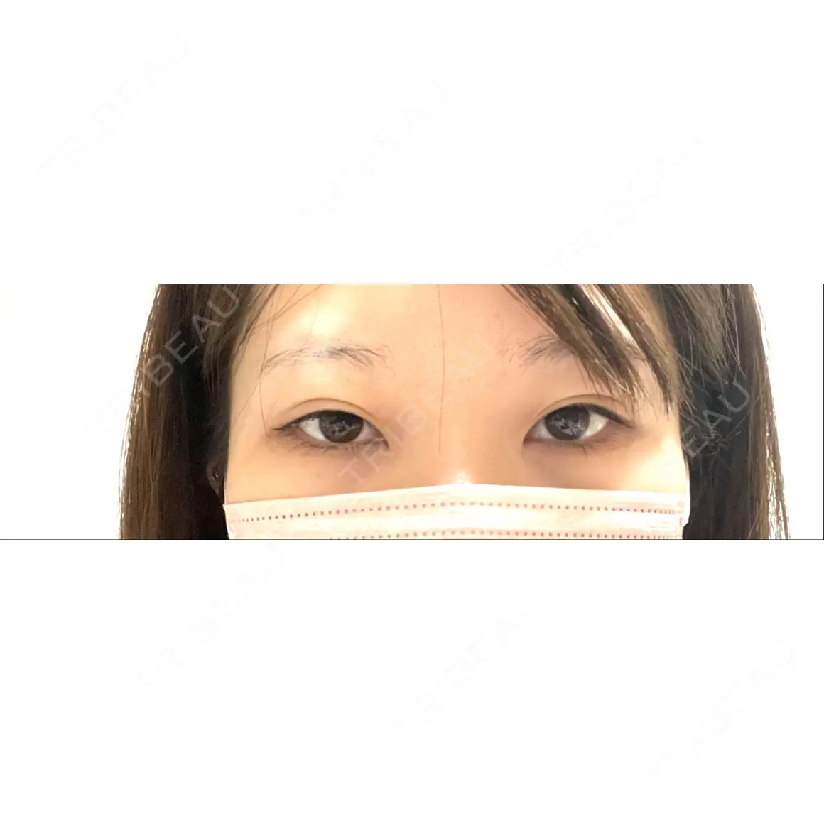 二重切開 / 眼瞼下垂（切開） / 目尻切開 サラ美容外科 AFTER