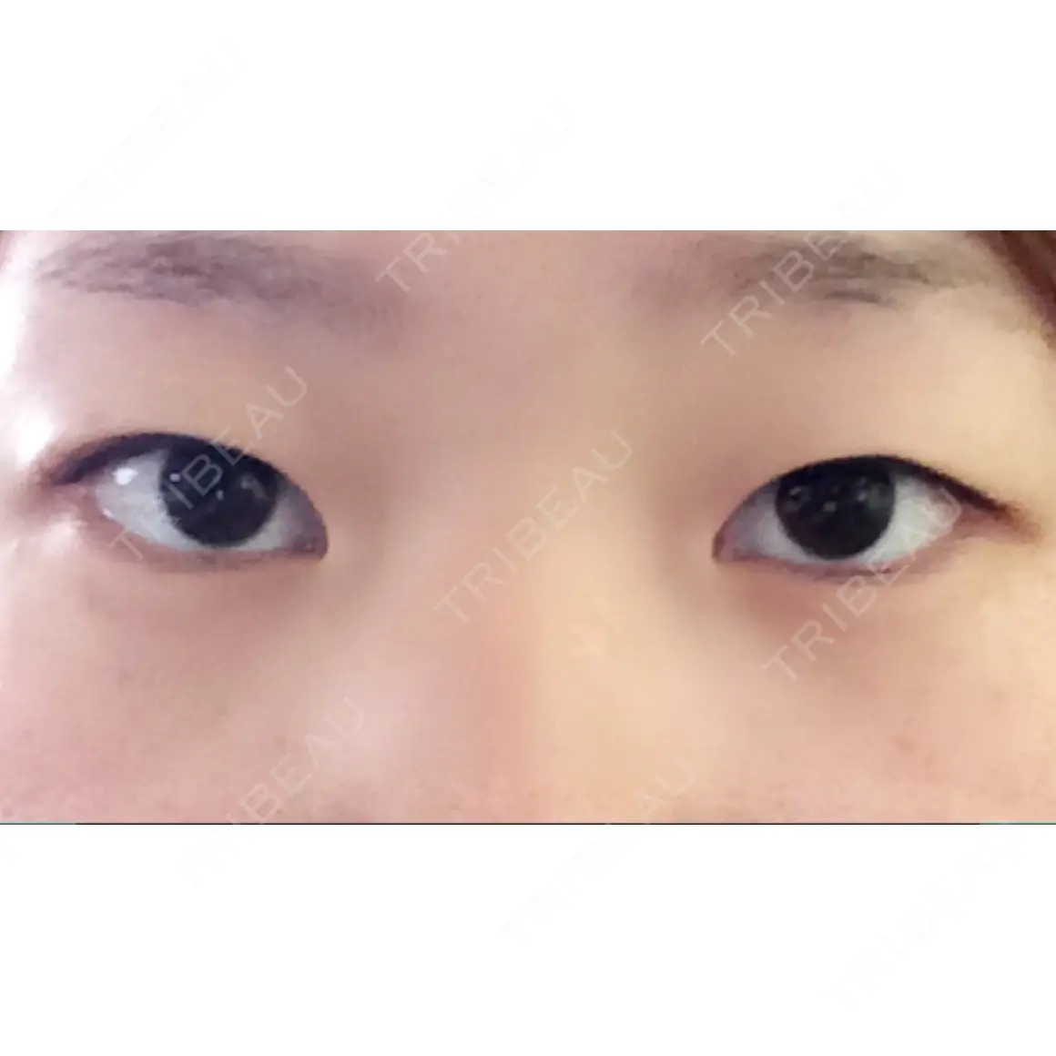 二重埋没 / 上まぶたの脂肪取り TCB東京中央美容外科 郡山院 AFTER