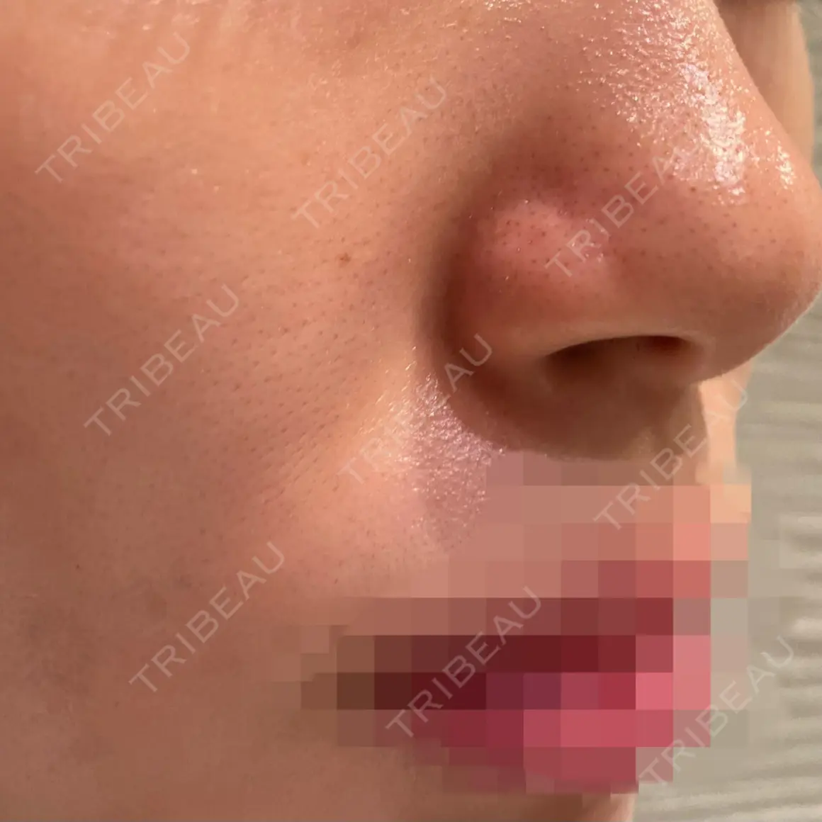 ダーマペン / 毛穴洗浄（ハイドラフェイシャルなど） B-LINE CLINIC 池袋院 AFTER