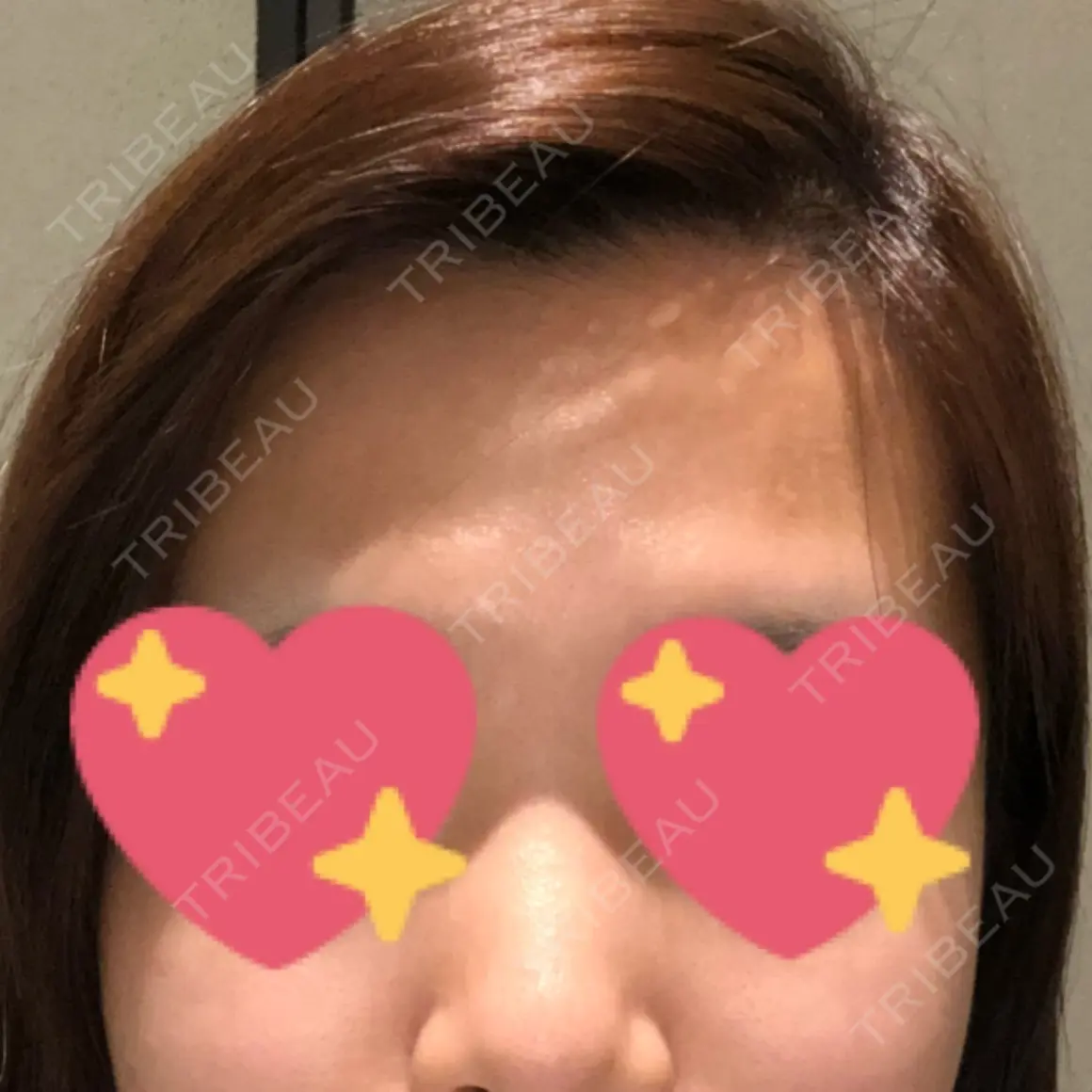 額を丸く / 脂肪注入（額） id（アイディ）美容外科 AFTER
